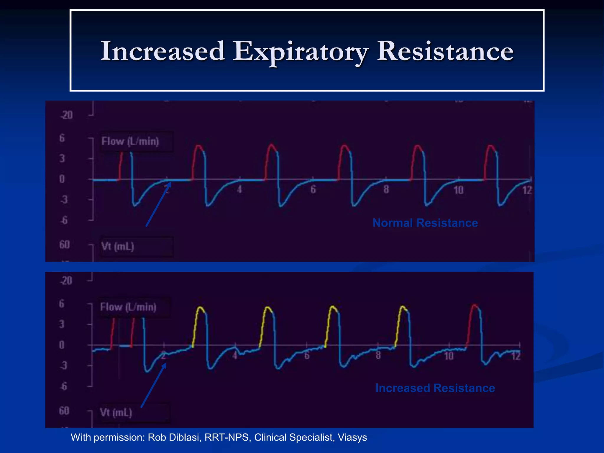 Increased Expiratory Resistance
Normal Resistance
Increased Resistance
With permission: Rob Diblasi, RRT-NPS, Clinical Specialist, Viasys
 