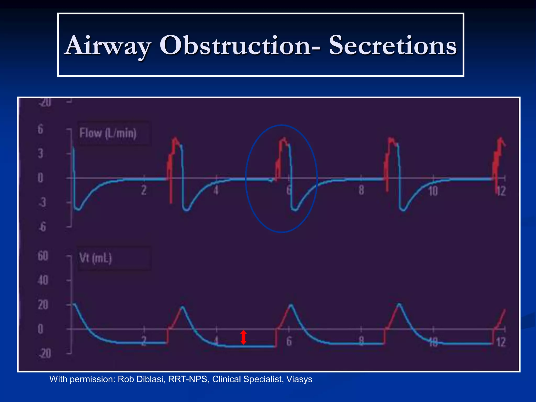 Airway Obstruction- Secretions
With permission: Rob Diblasi, RRT-NPS, Clinical Specialist, Viasys
 
