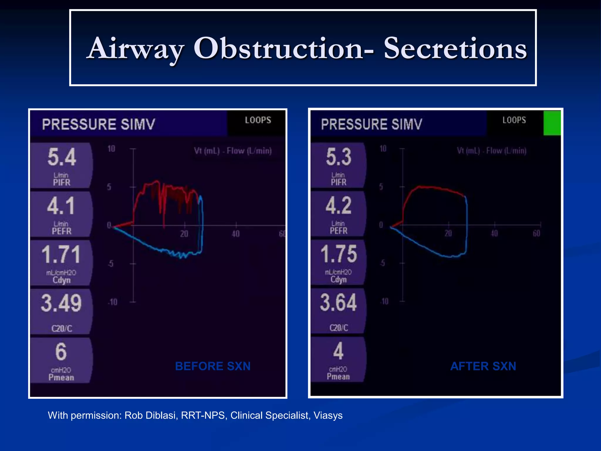 Airway Obstruction- Secretions
BEFORE SXN AFTER SXN
With permission: Rob Diblasi, RRT-NPS, Clinical Specialist, Viasys
 