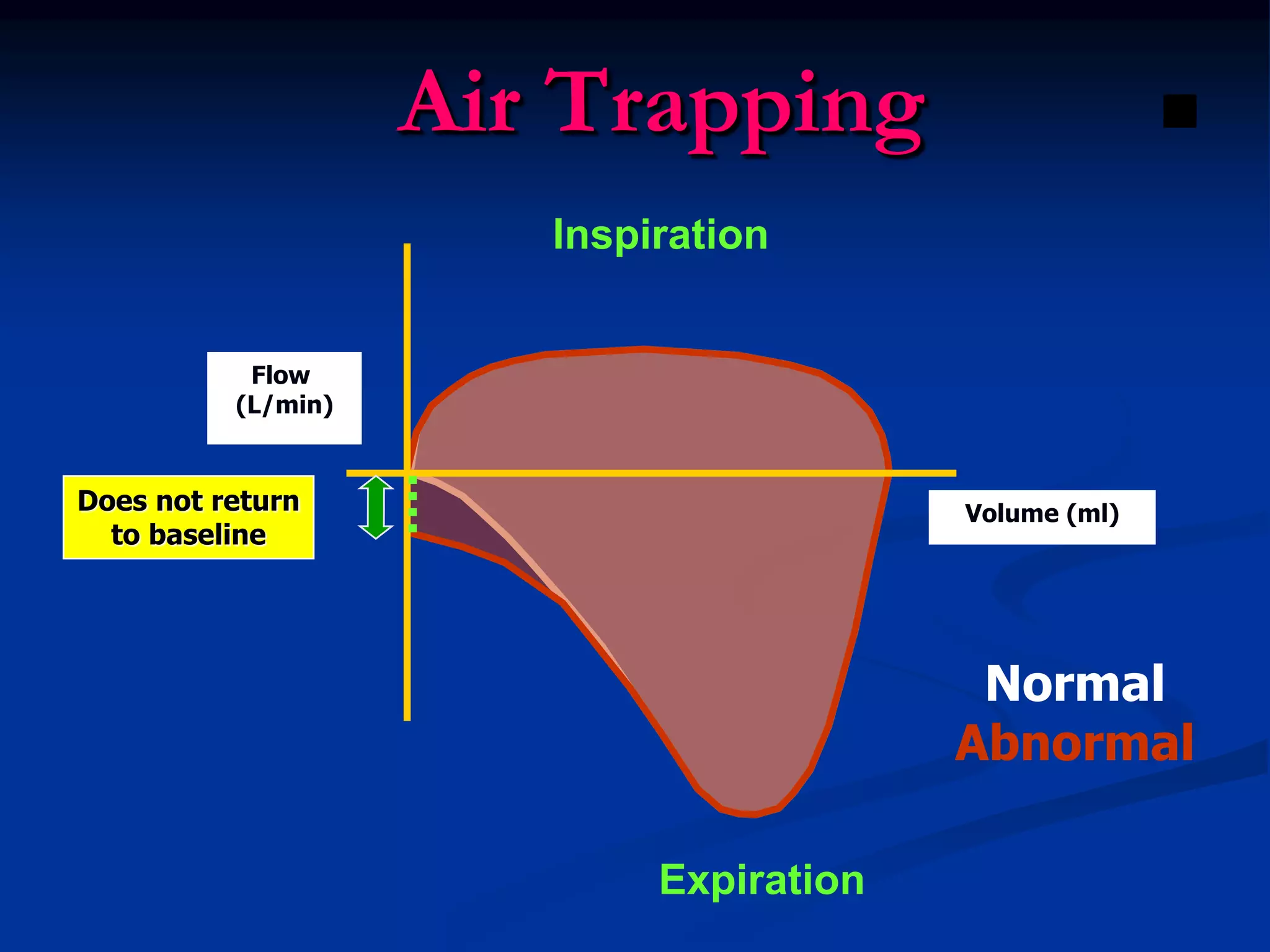 Air Trapping
Inspiration
Expiration
Volume (ml)
Flow
(L/min)
Does not return
to baseline
Normal
Abnormal
 