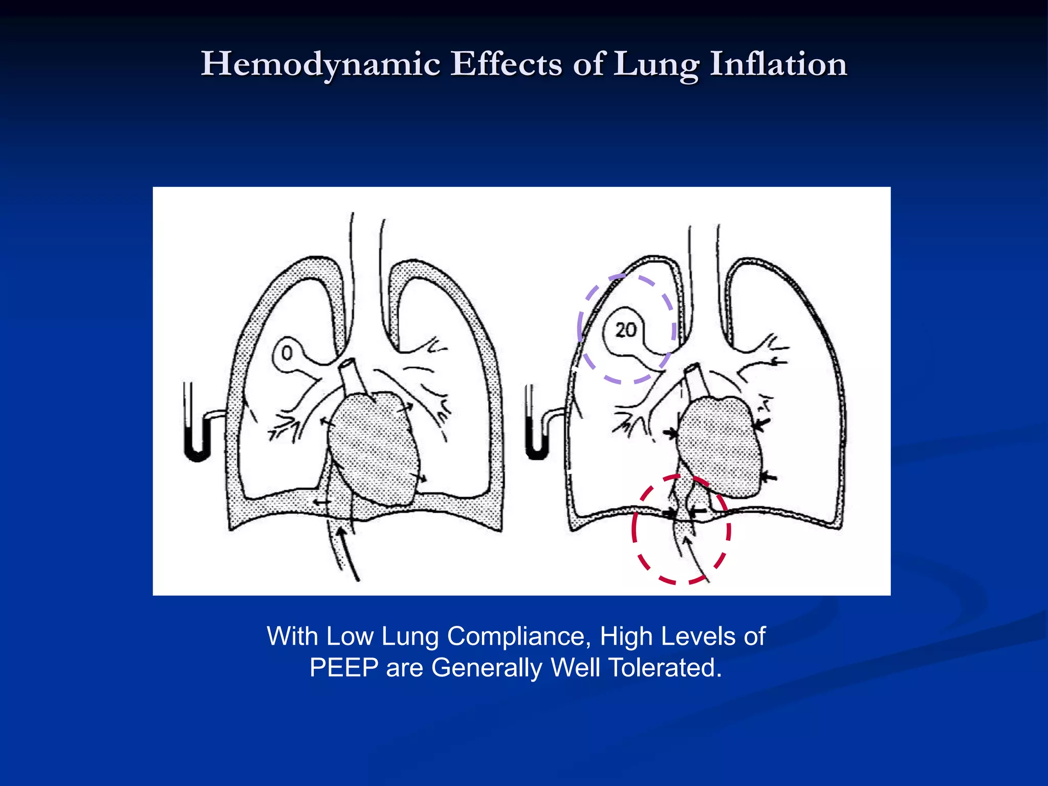 Hemodynamic Effects of Lung Inflation
With Low Lung Compliance, High Levels of
PEEP are Generally Well Tolerated.
 