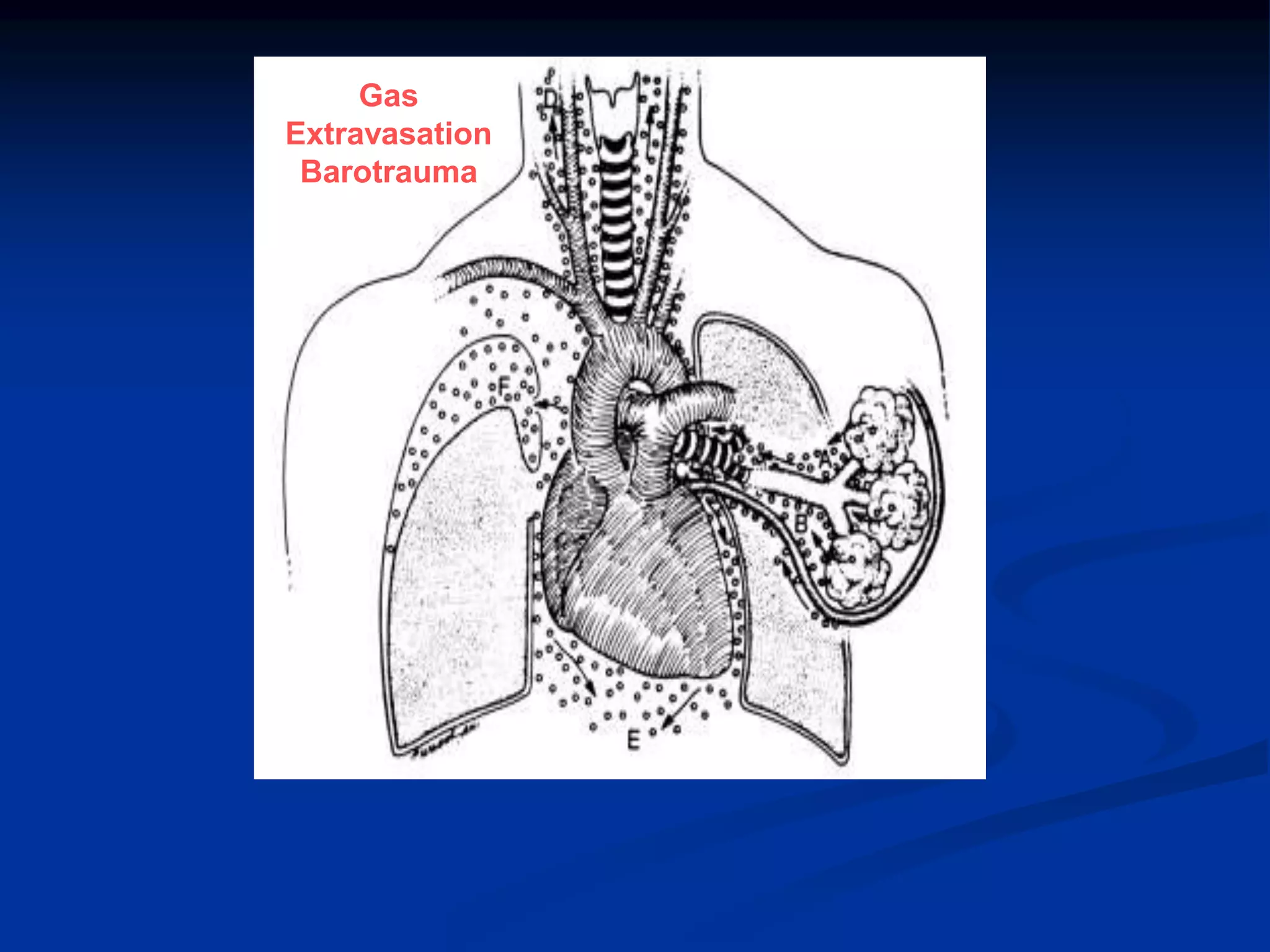 Gas
Extravasation
Barotrauma
 