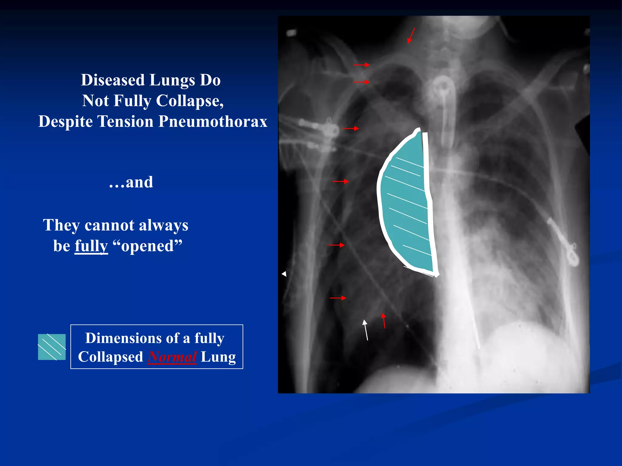 Diseased Lungs Do
Not Fully Collapse,
Despite Tension Pneumothorax
…and
They cannot always
be fully “opened”
Dimensions of a fully
Collapsed Normal Lung
 
