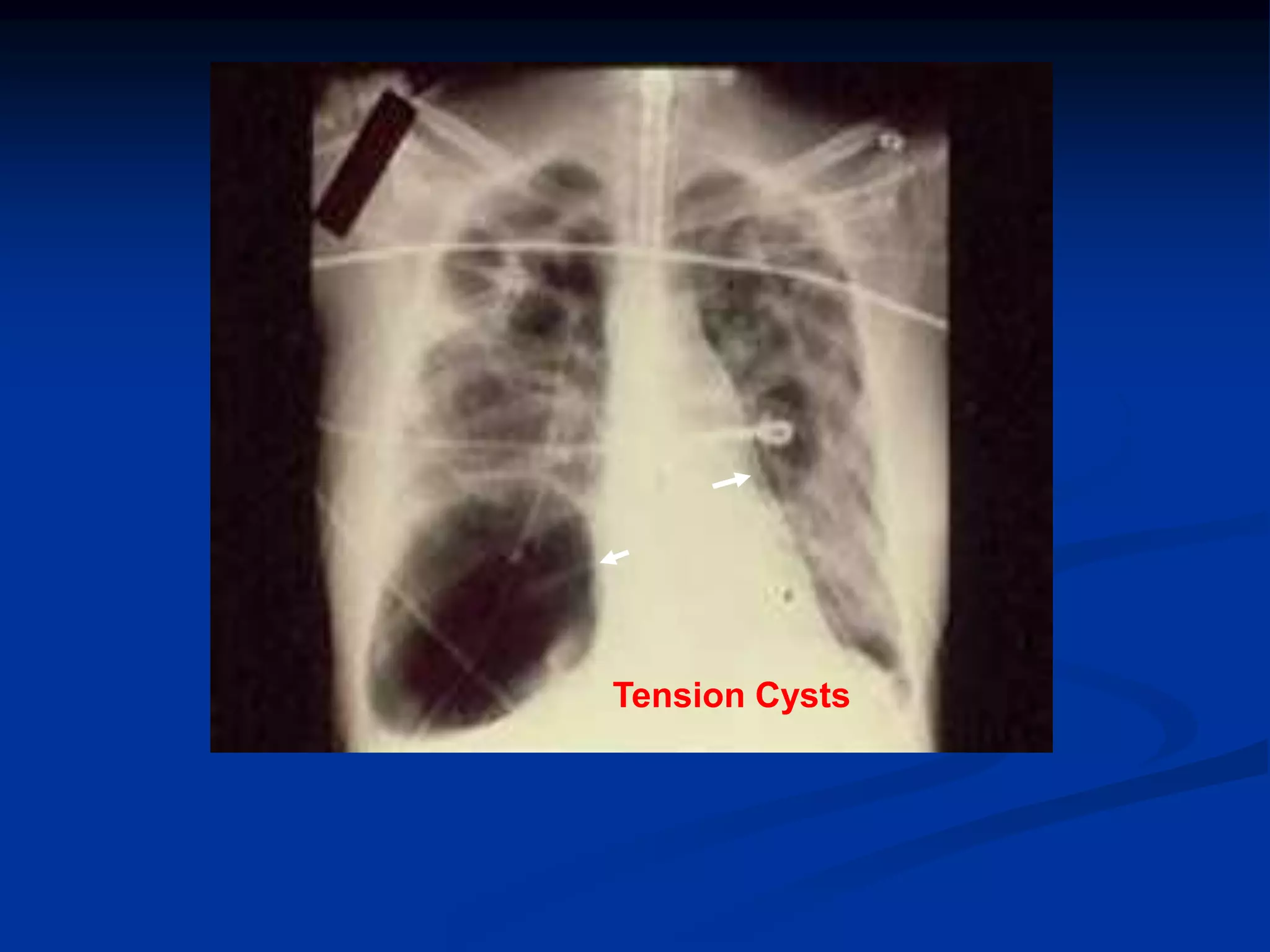 Tension Cysts
 
