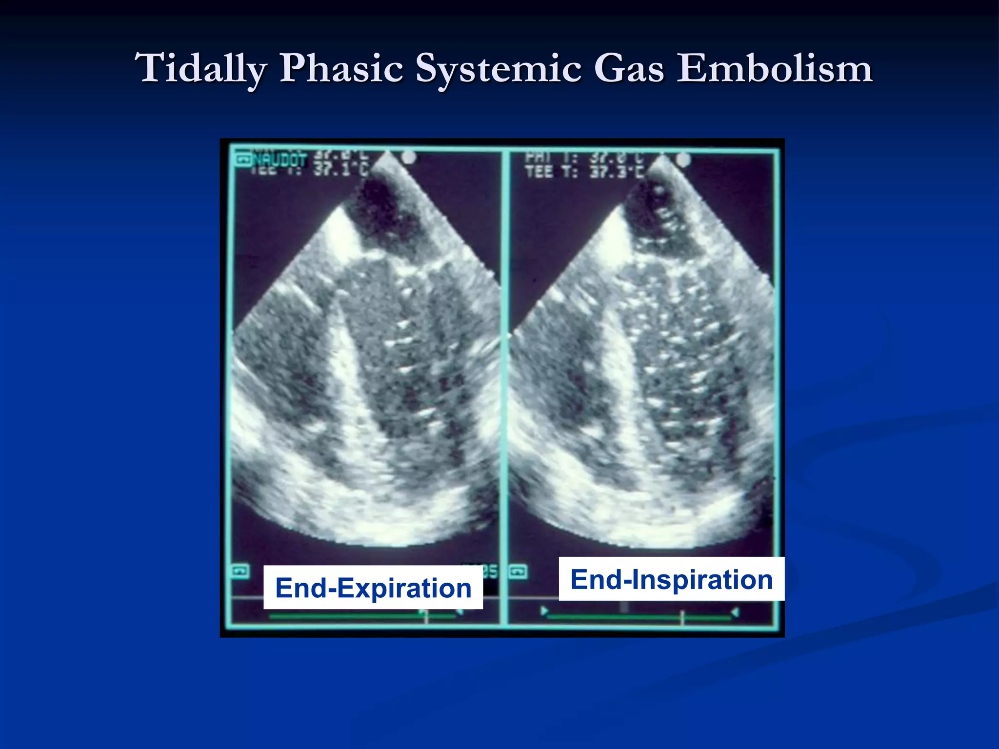 Tidally Phasic Systemic Gas Embolism
End-Expiration End-Inspiration
 
