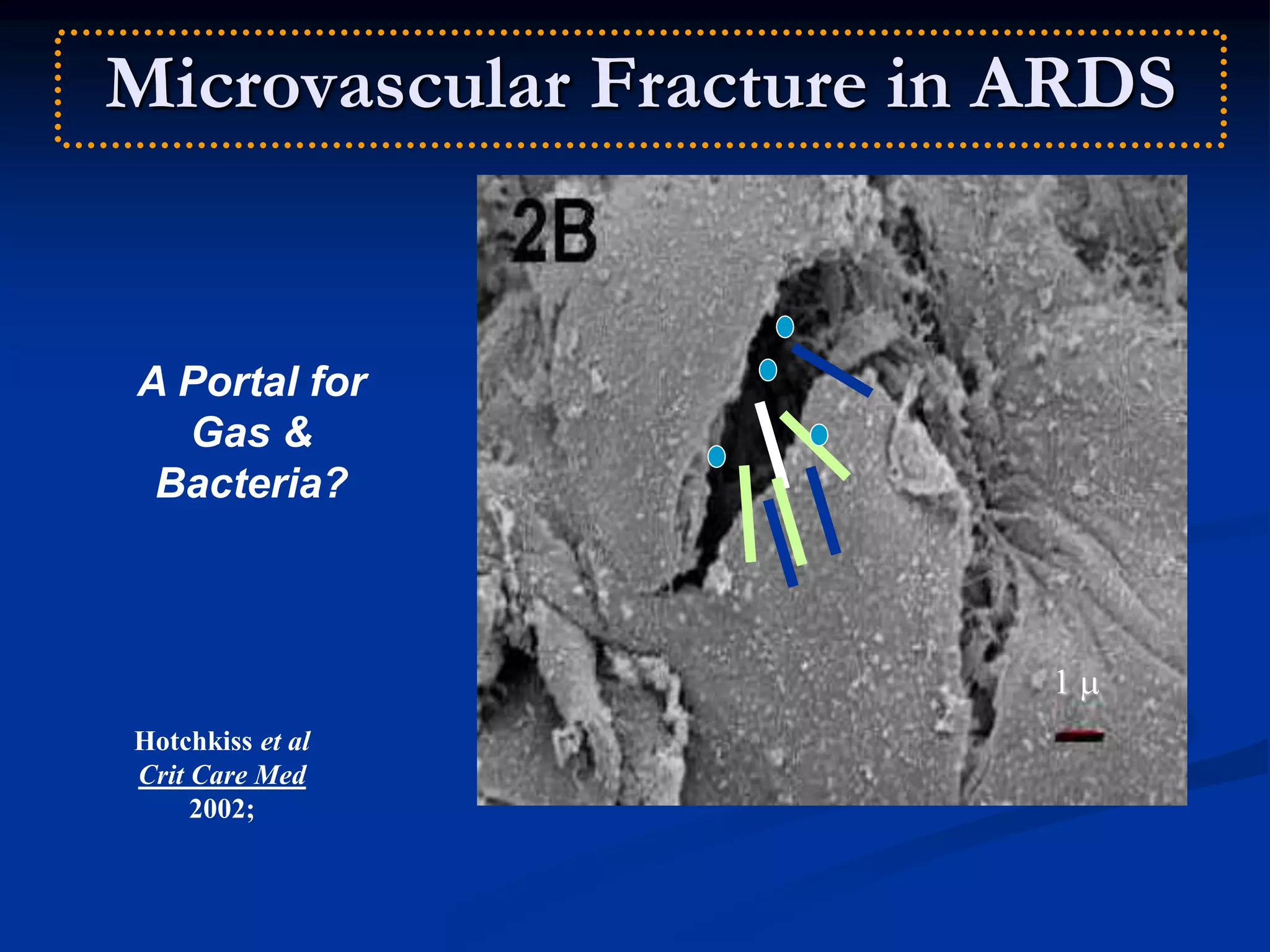 Microvascular Fracture in ARDS
A Portal for
Gas &
Bacteria?
Hotchkiss et al
Crit Care Med
2002;
1 
 