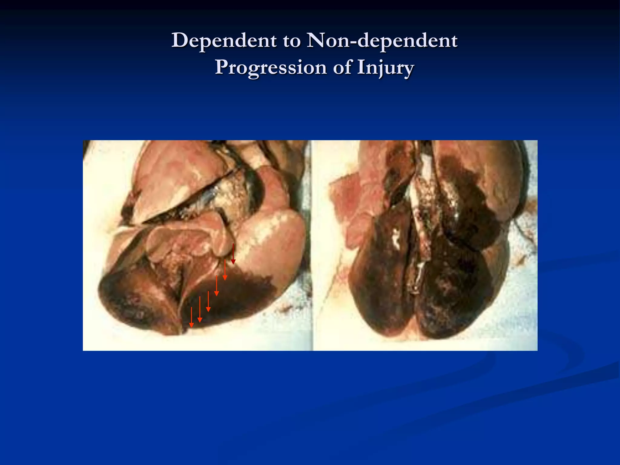 Dependent to Non-dependent
Progression of Injury
 