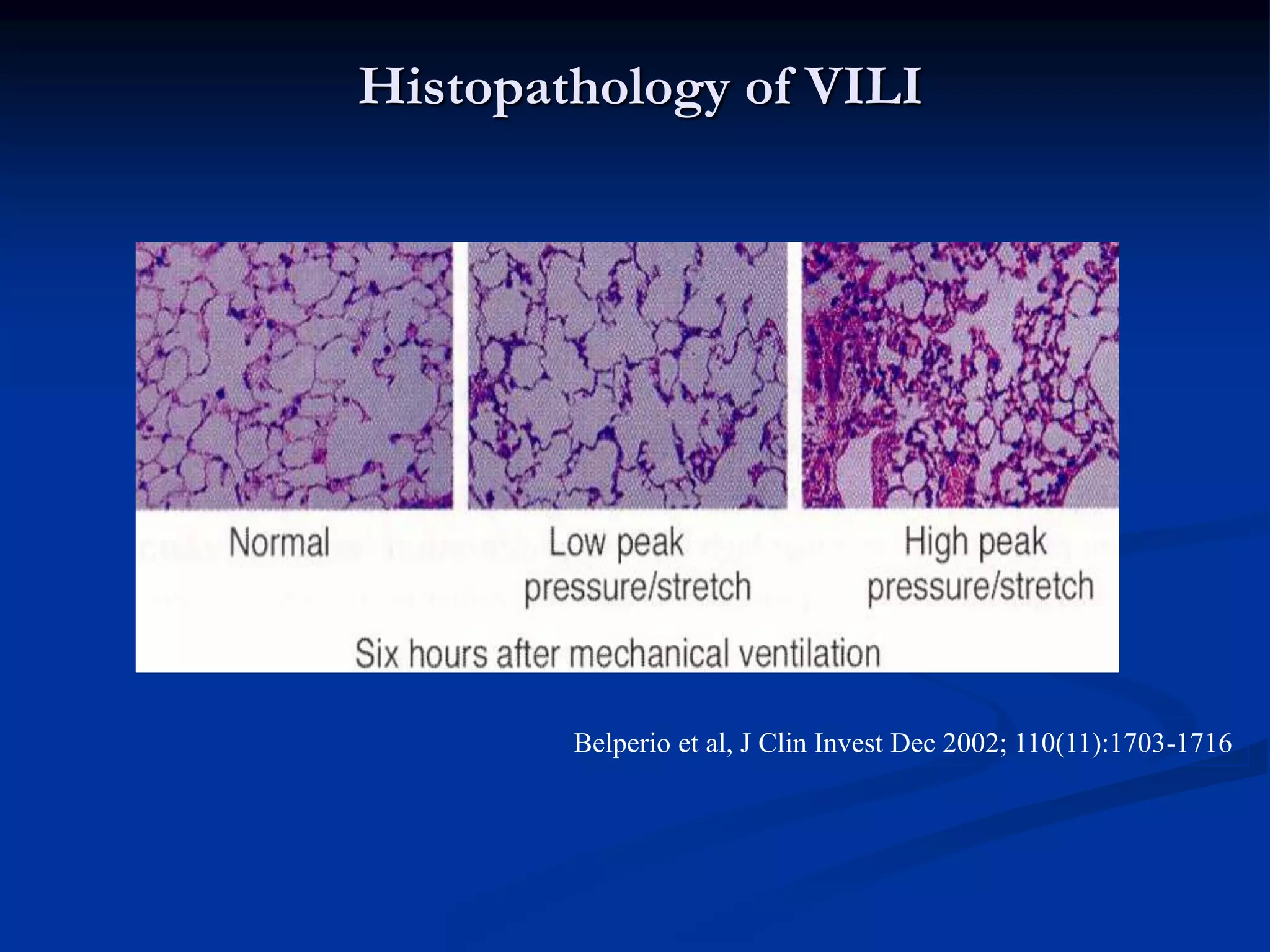 Histopathology of VILI
Belperio et al, J Clin Invest Dec 2002; 110(11):1703-1716
 