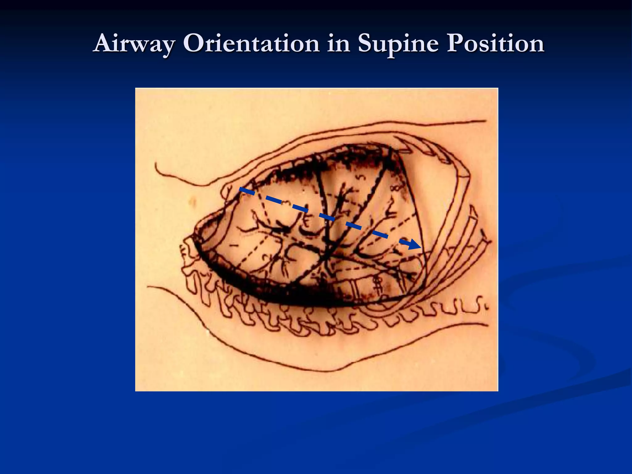 Airway Orientation in Supine Position
 