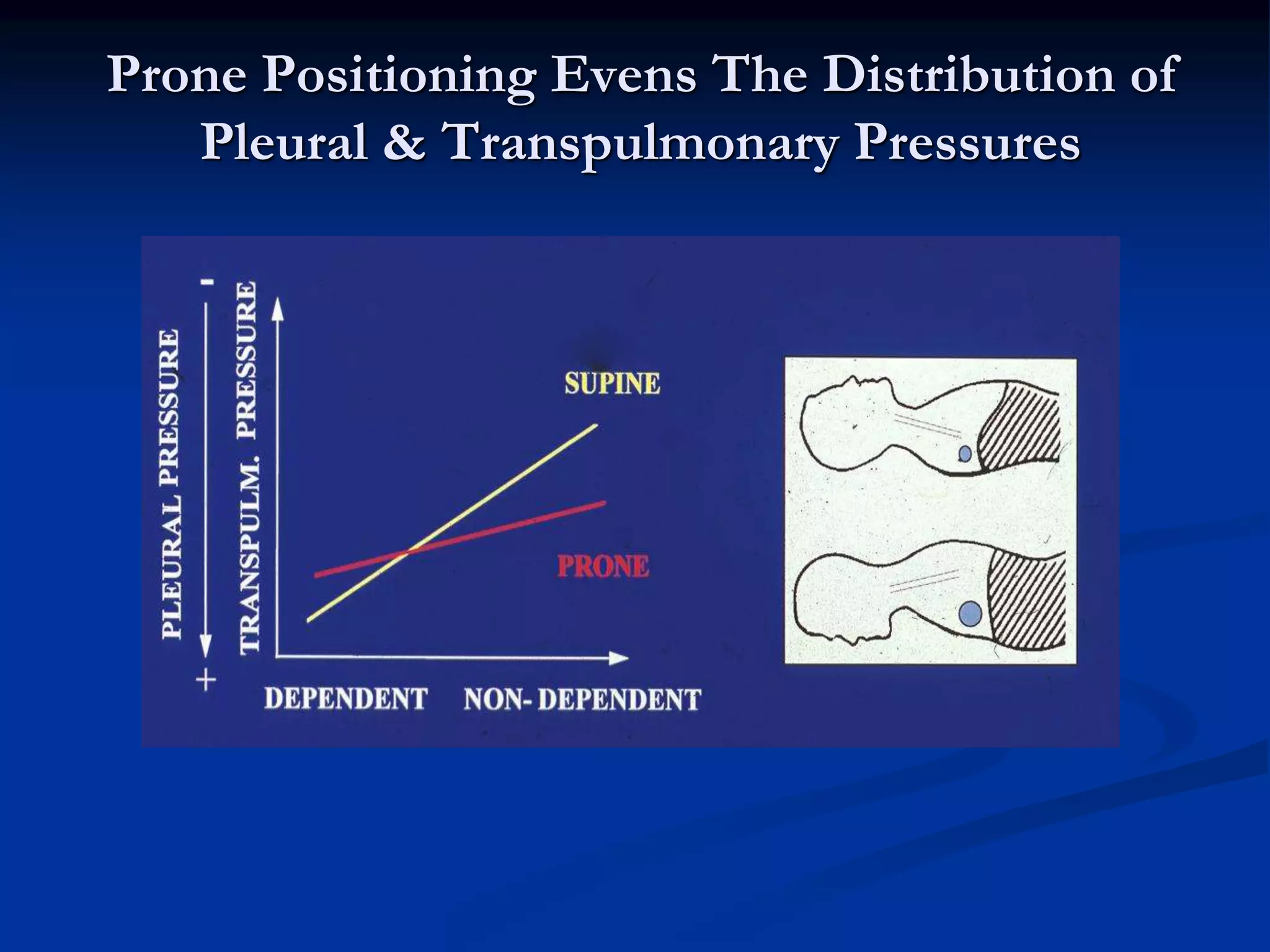 Prone Positioning Evens The Distribution of
Pleural & Transpulmonary Pressures
 