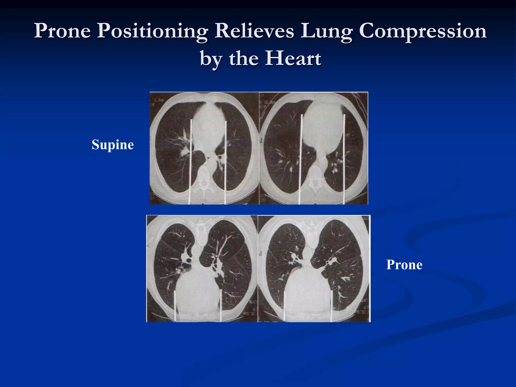 Prone Positioning Relieves Lung Compression
by the Heart
Supine
Prone
 