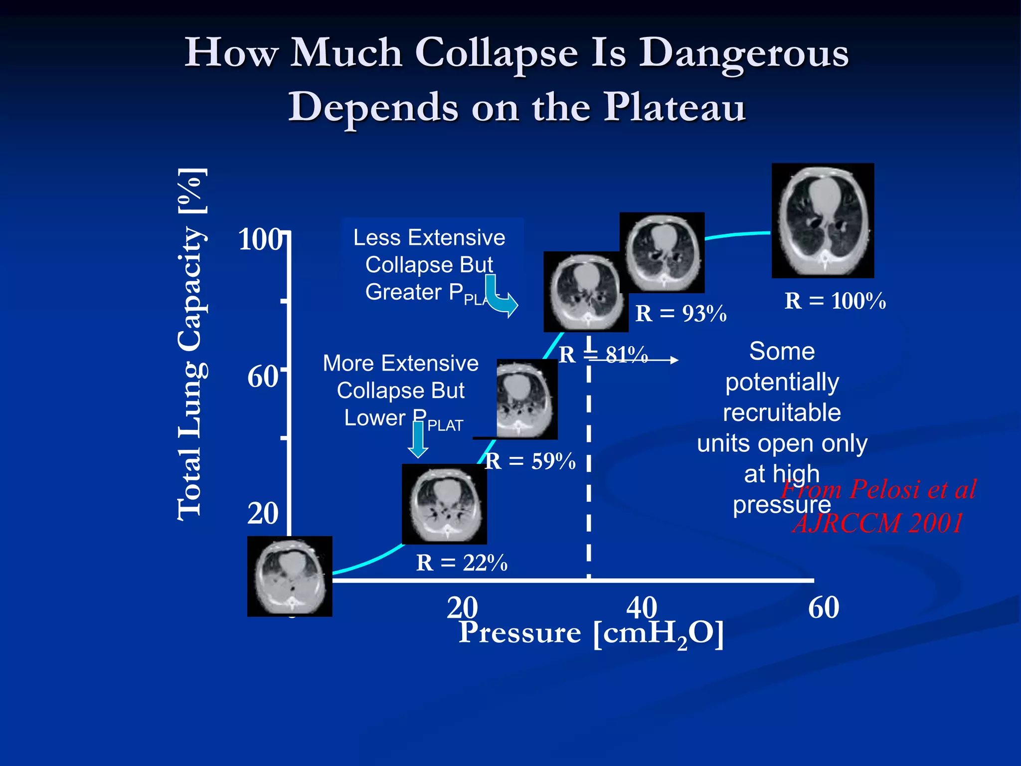 How Much Collapse Is Dangerous
Depends on the Plateau
R = 100%
20
60
100
Pressure [cmH2O]
20 40 60
TotalLungCapacity[%]
R = 22%
R = 81%
R = 93%
0
0
R = 0%
R = 59%
From Pelosi et al
AJRCCM 2001
Some
potentially
recruitable
units open only
at high
pressure
More Extensive
Collapse But
Lower PPLAT
Less Extensive
Collapse But
Greater PPLAT
 