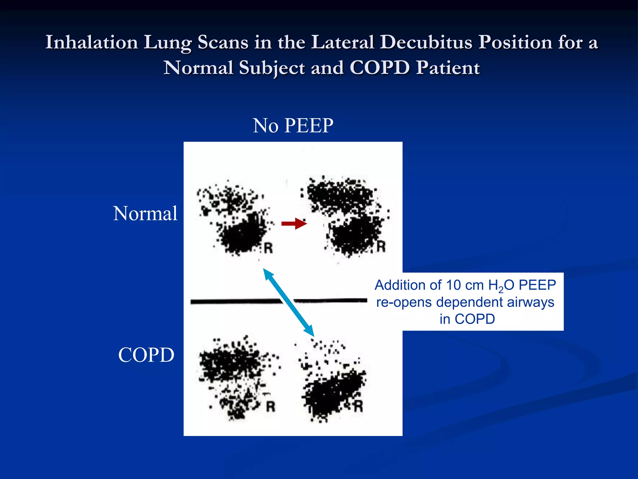 Inhalation Lung Scans in the Lateral Decubitus Position for a
Normal Subject and COPD Patient
Normal
COPD
No PEEP
PEEP10
Addition of 10 cm H2O PEEP
re-opens dependent airways
in COPD
 