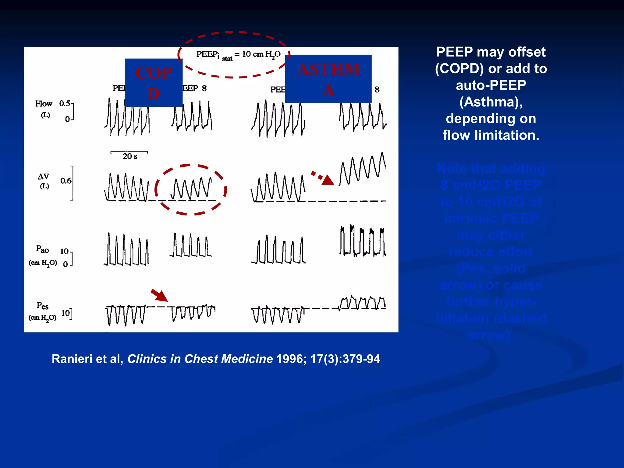 PEEP may offset
(COPD) or add to
auto-PEEP
(Asthma),
depending on
flow limitation.
Note that adding
8 cmH2O PEEP
to 10 cmH2O of
intrinsic PEEP
may either
reduce effort
(Pes, solid
arrow) or cause
further hyper-
inflation (dashed
arrow).
Ranieri et al, Clinics in Chest Medicine 1996; 17(3):379-94
ASTHM
A
COP
D
 