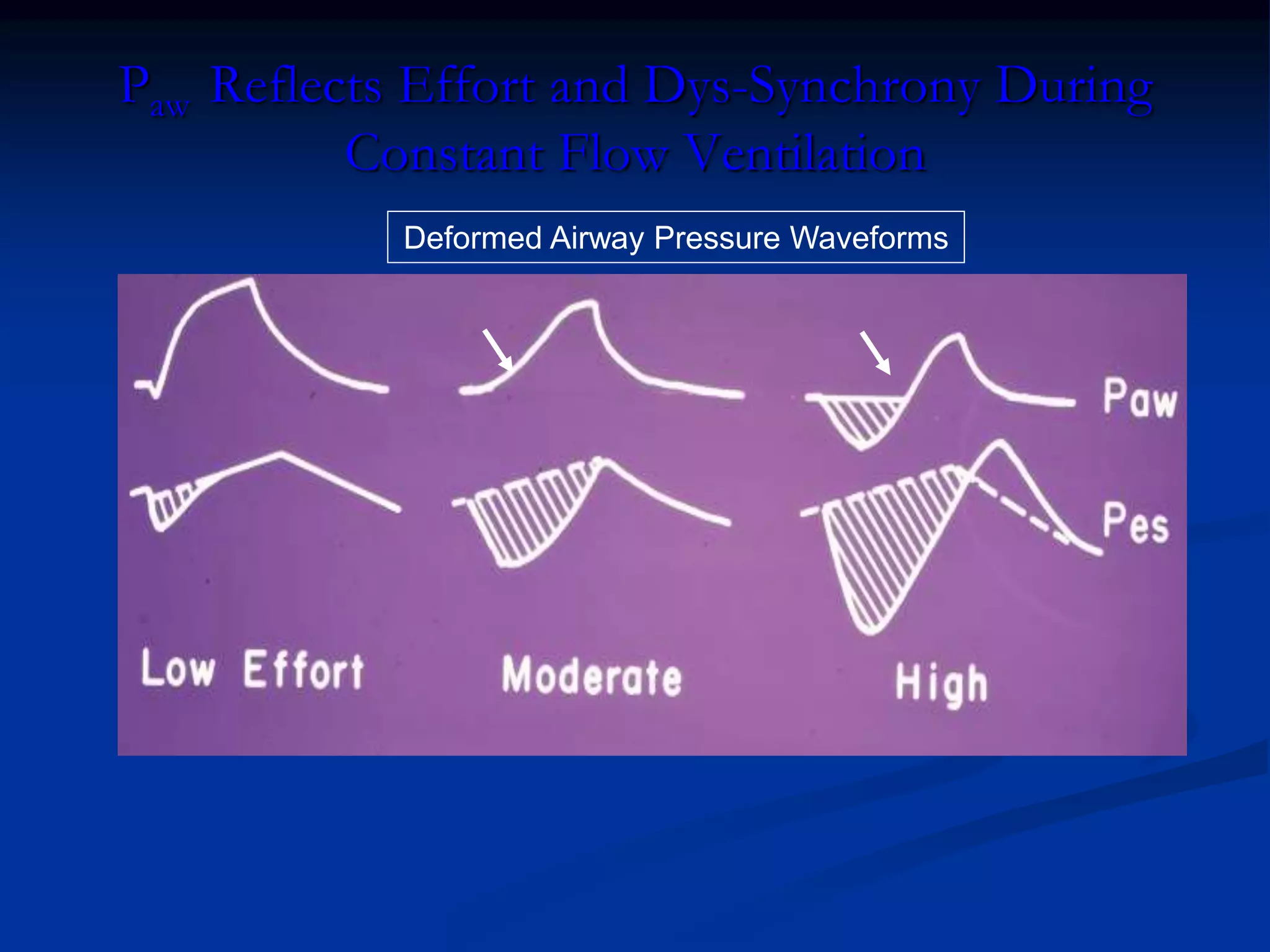 Deformed Airway Pressure Waveforms
Paw Reflects Effort and Dys-Synchrony During
Constant Flow Ventilation
 