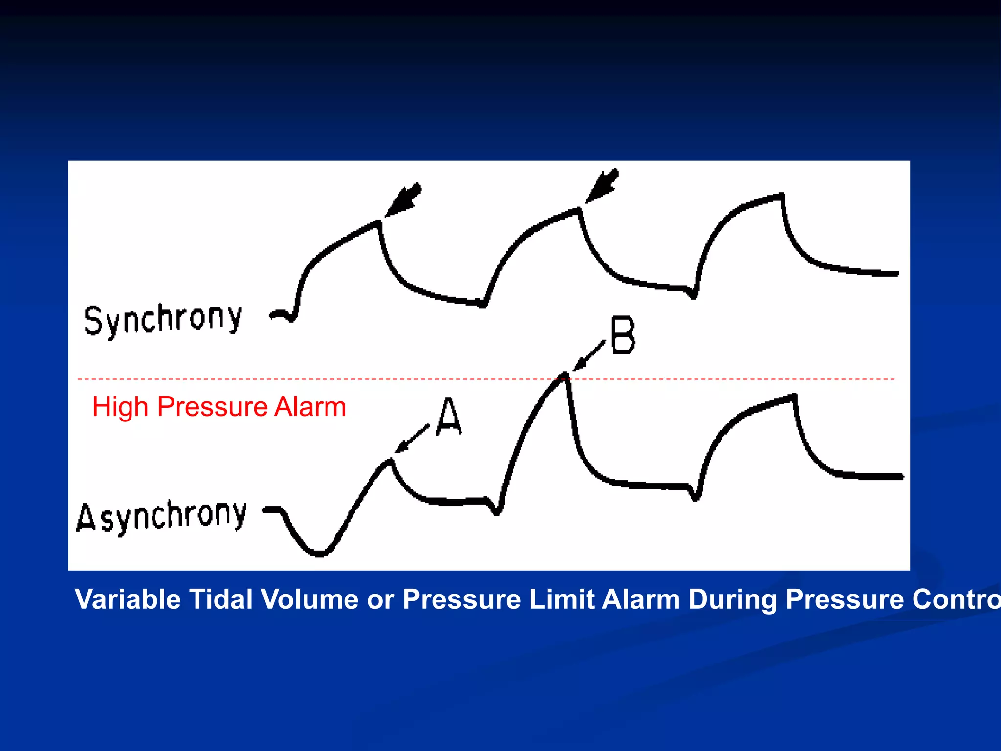 High Pressure Alarm
Variable Tidal Volume or Pressure Limit Alarm During Pressure Contro
 