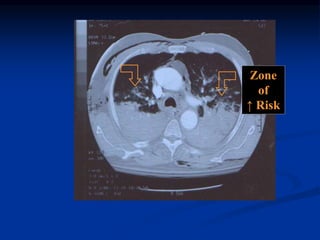 Basics of mechanical ventilation | PPSX