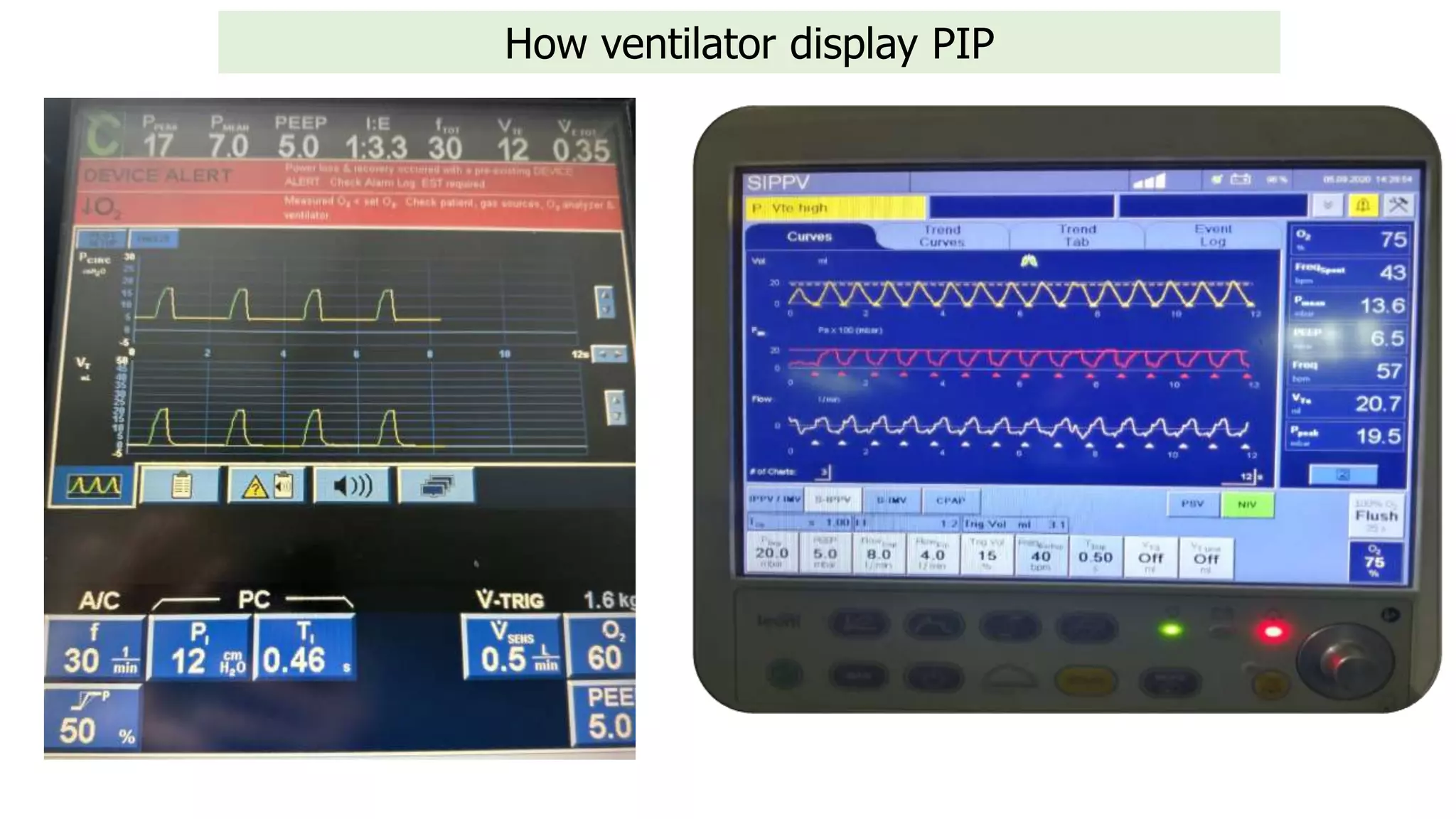 How ventilator display PIP
 