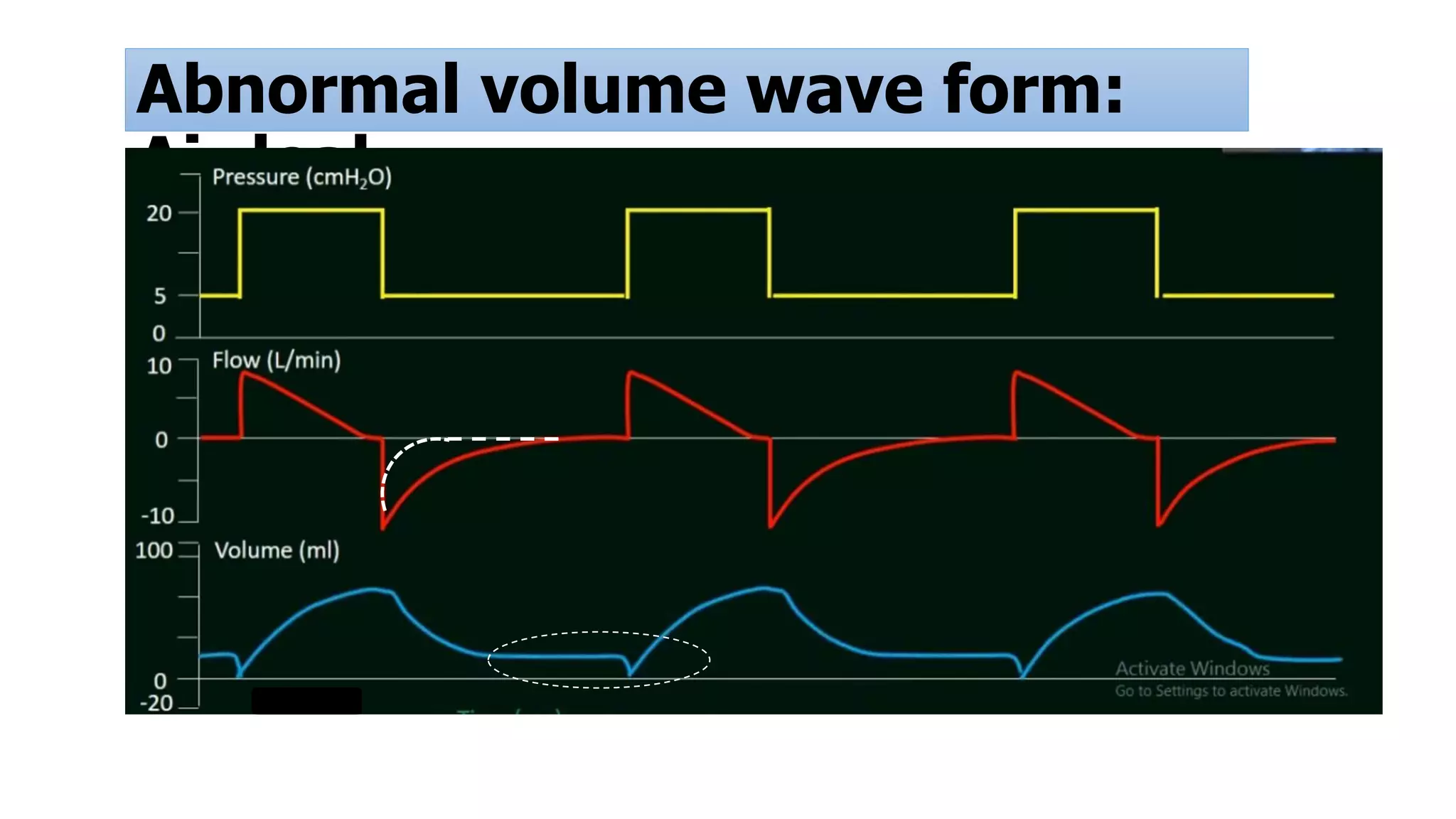 Abnormal volume wave form:
Air leak
 