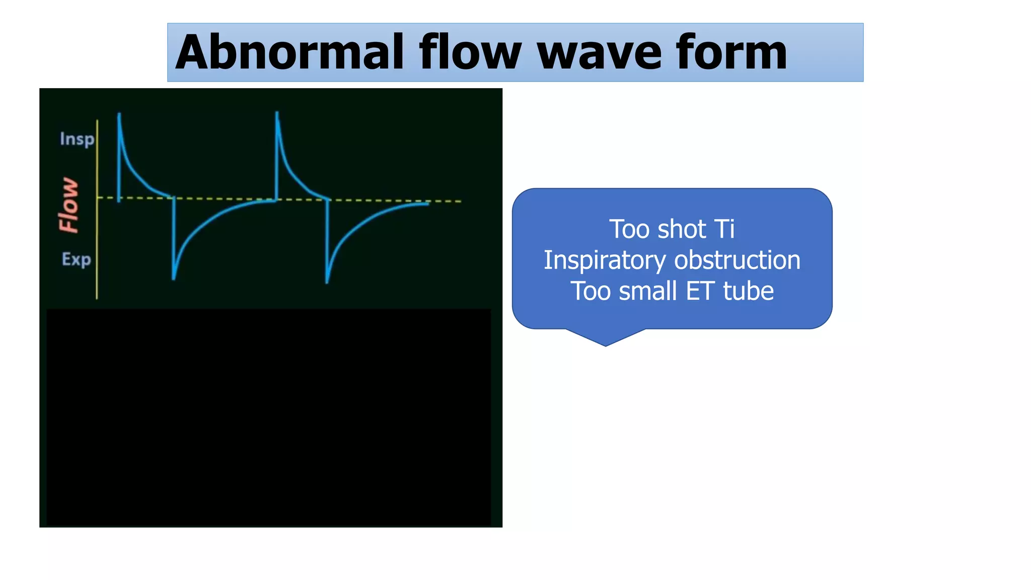 Abnormal flow wave form
Too shot Ti
Inspiratory obstruction
Too small ET tube
 