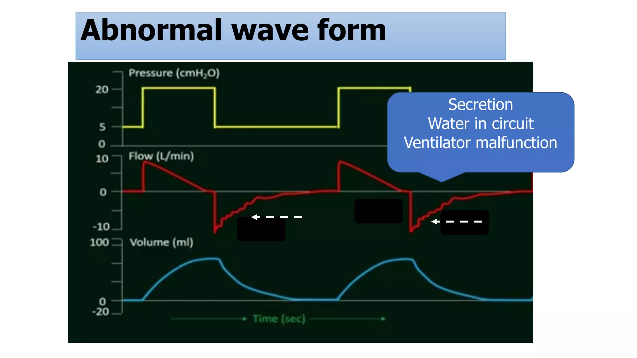 Abnormal wave form
Secretion
Water in circuit
Ventilator malfunction
 