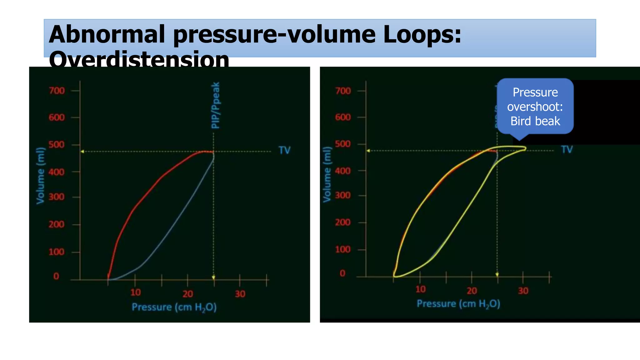 Abnormal pressure-volume Loops:
Overdistension
Pressure
overshoot:
Bird beak
 