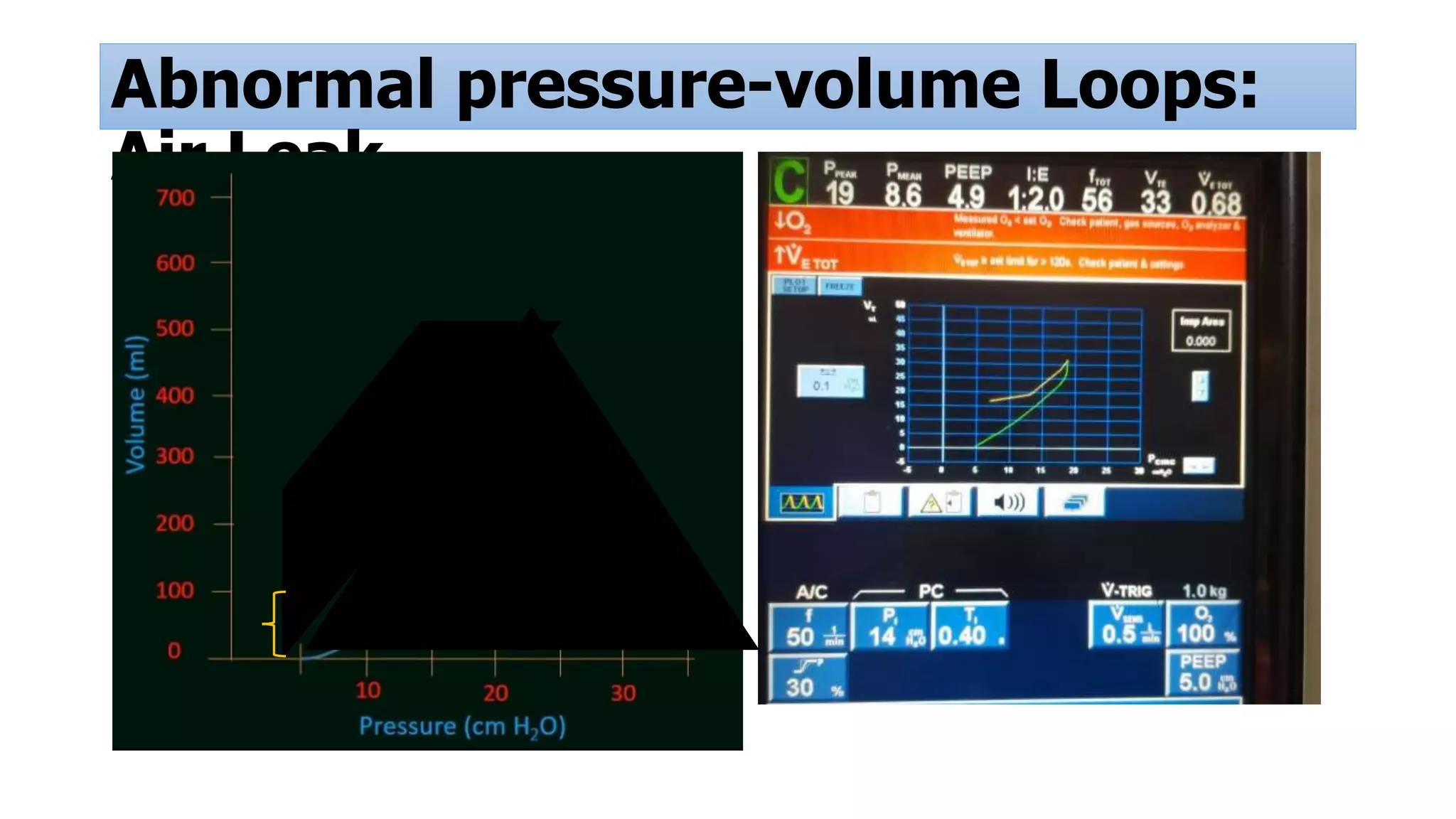 Abnormal pressure-volume Loops:
Air Leak
 