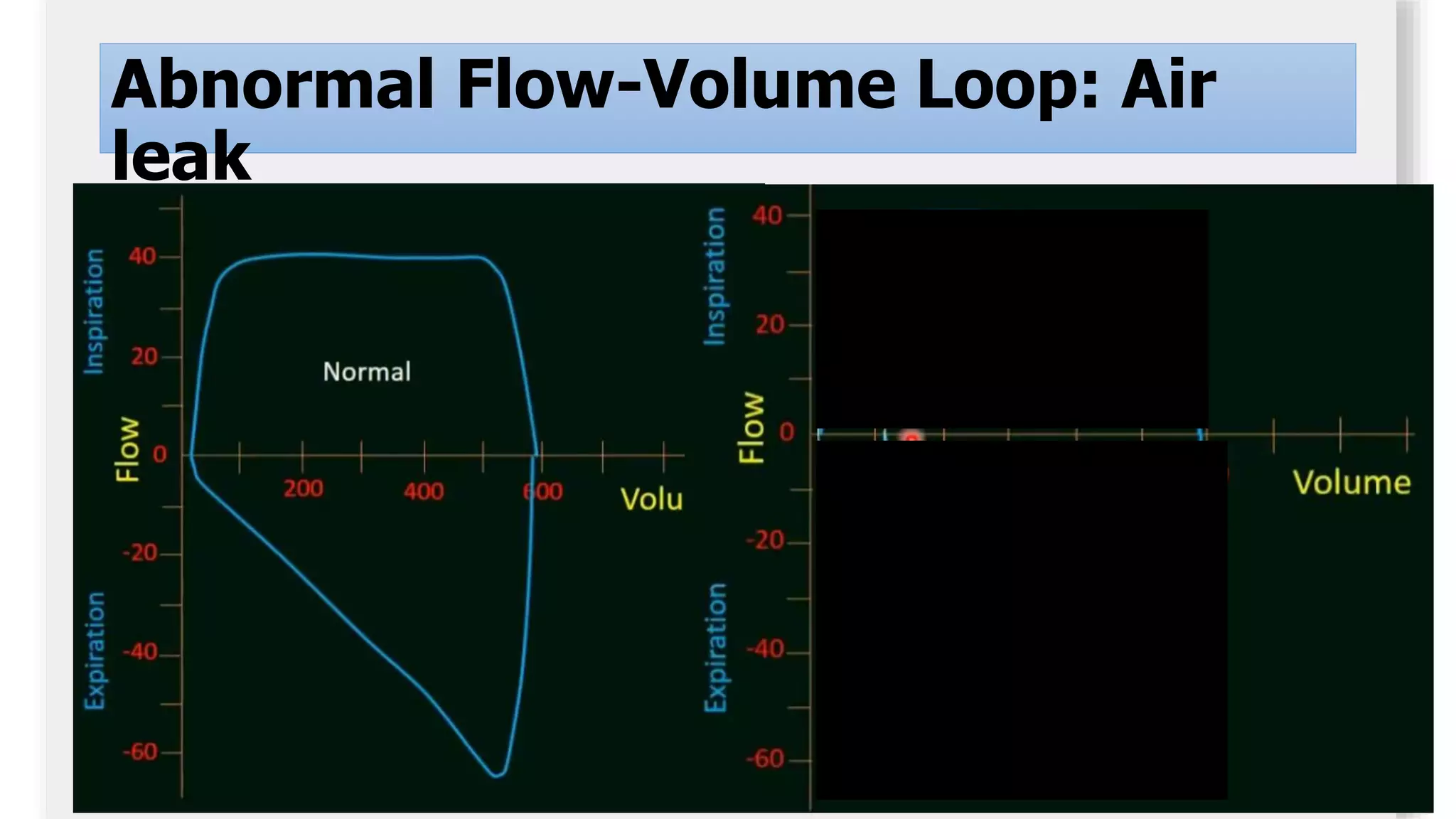 Adequac
y
Abnormal Flow-Volume Loop: Air
leak
 