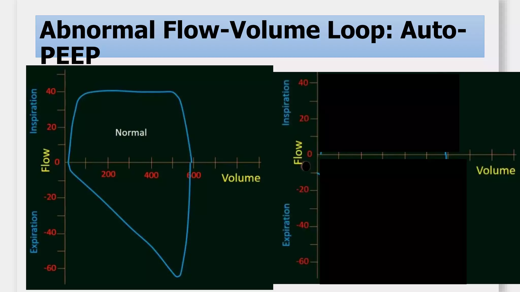 Basics
Adequac
y
Abnormal Flow-Volume Loop: Auto-
PEEP
 