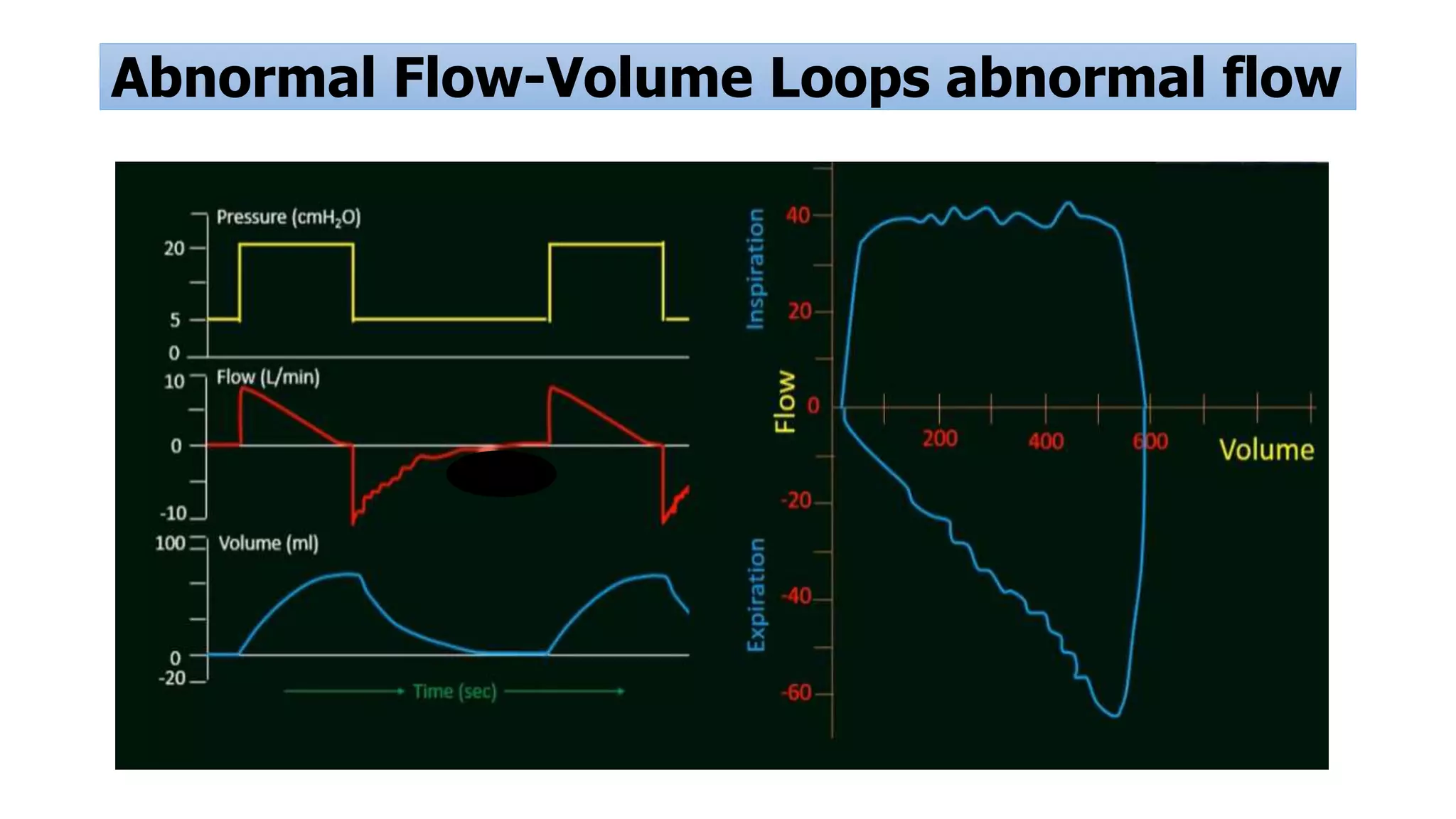 Abnormal Flow-Volume Loops abnormal flow
 