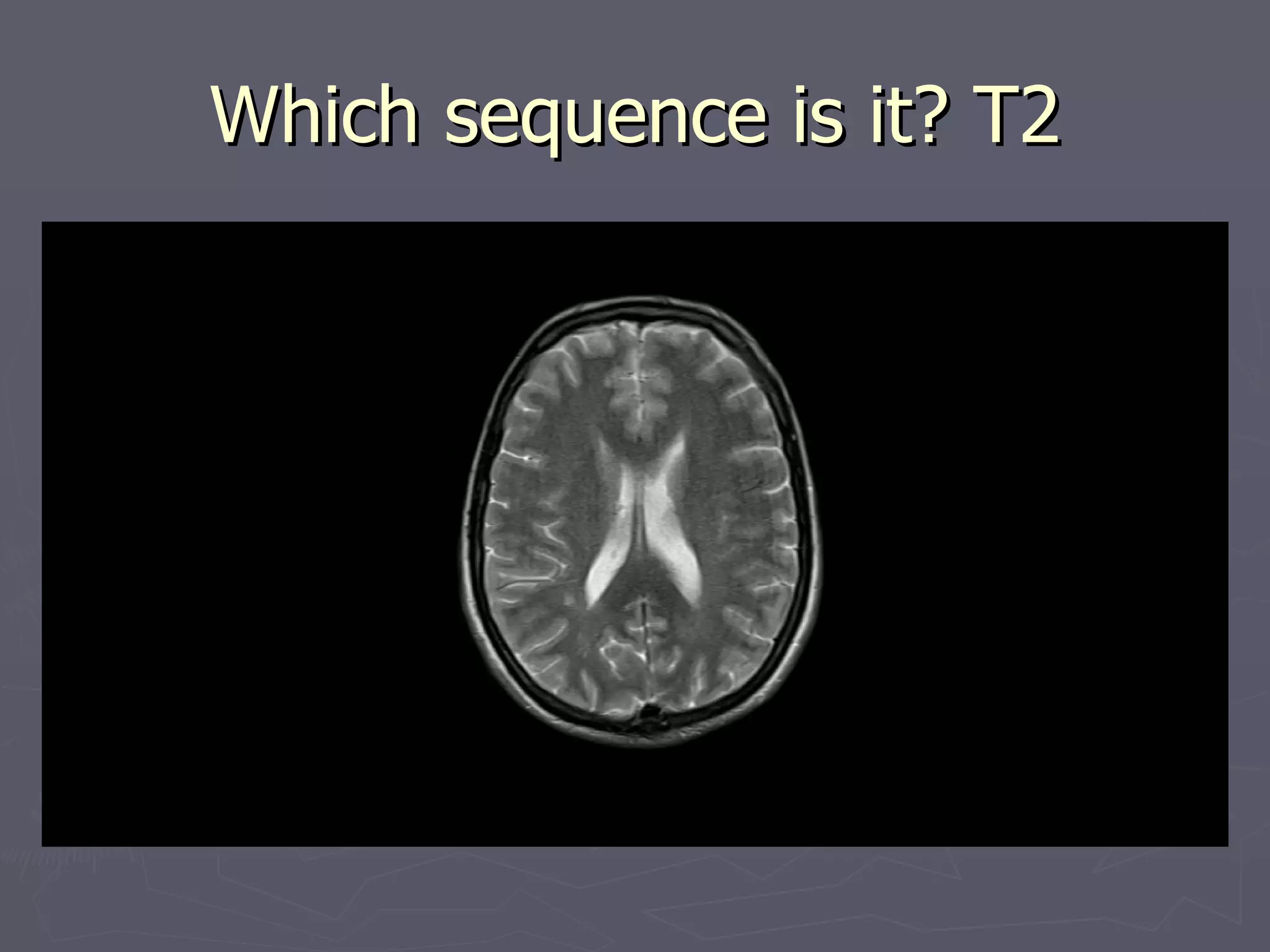 Which sequence is it? T2 