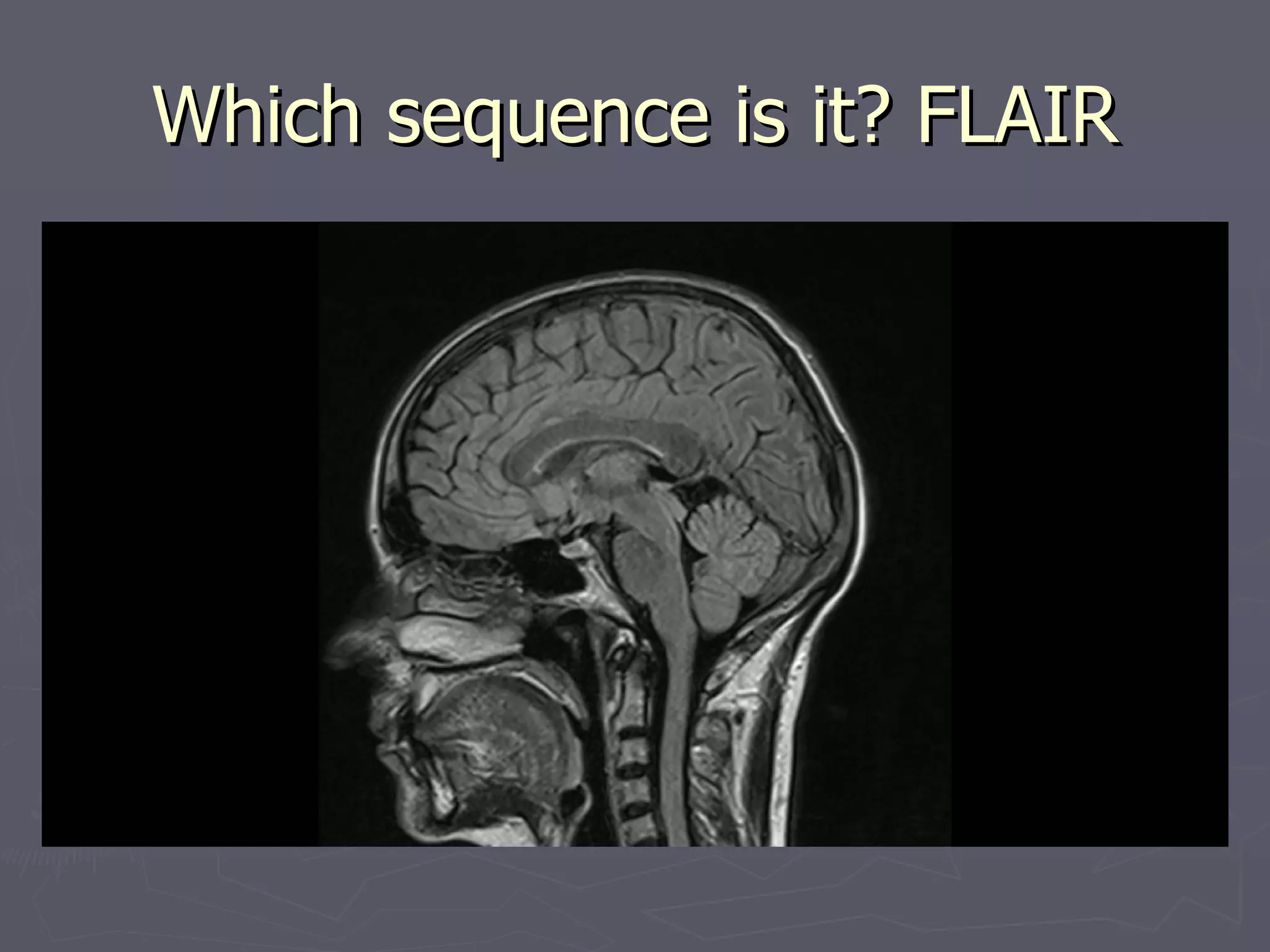 Which sequence is it? FLAIR 