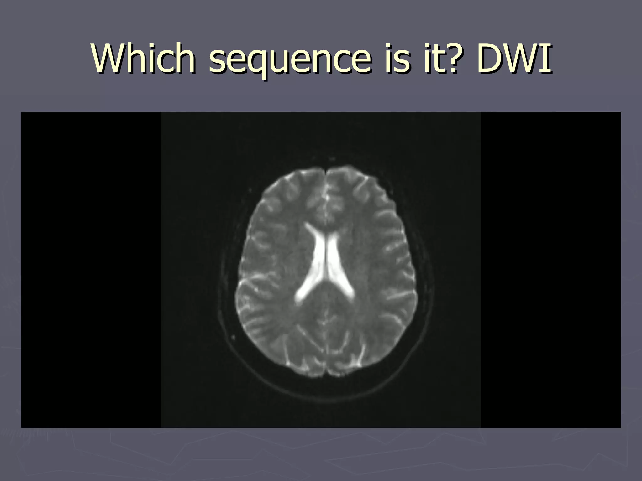 Which sequence is it? DWI 