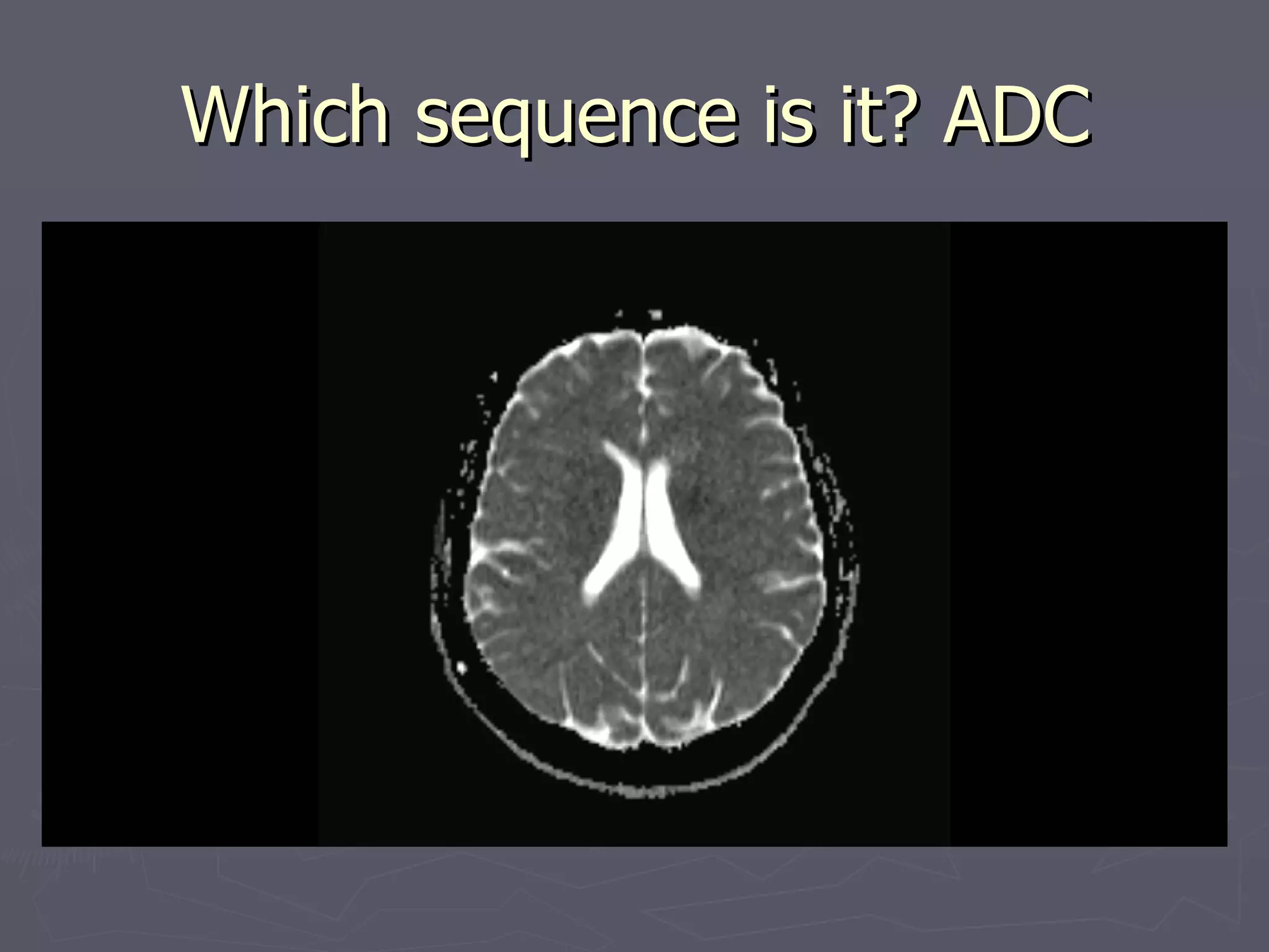 Which sequence is it? ADC 