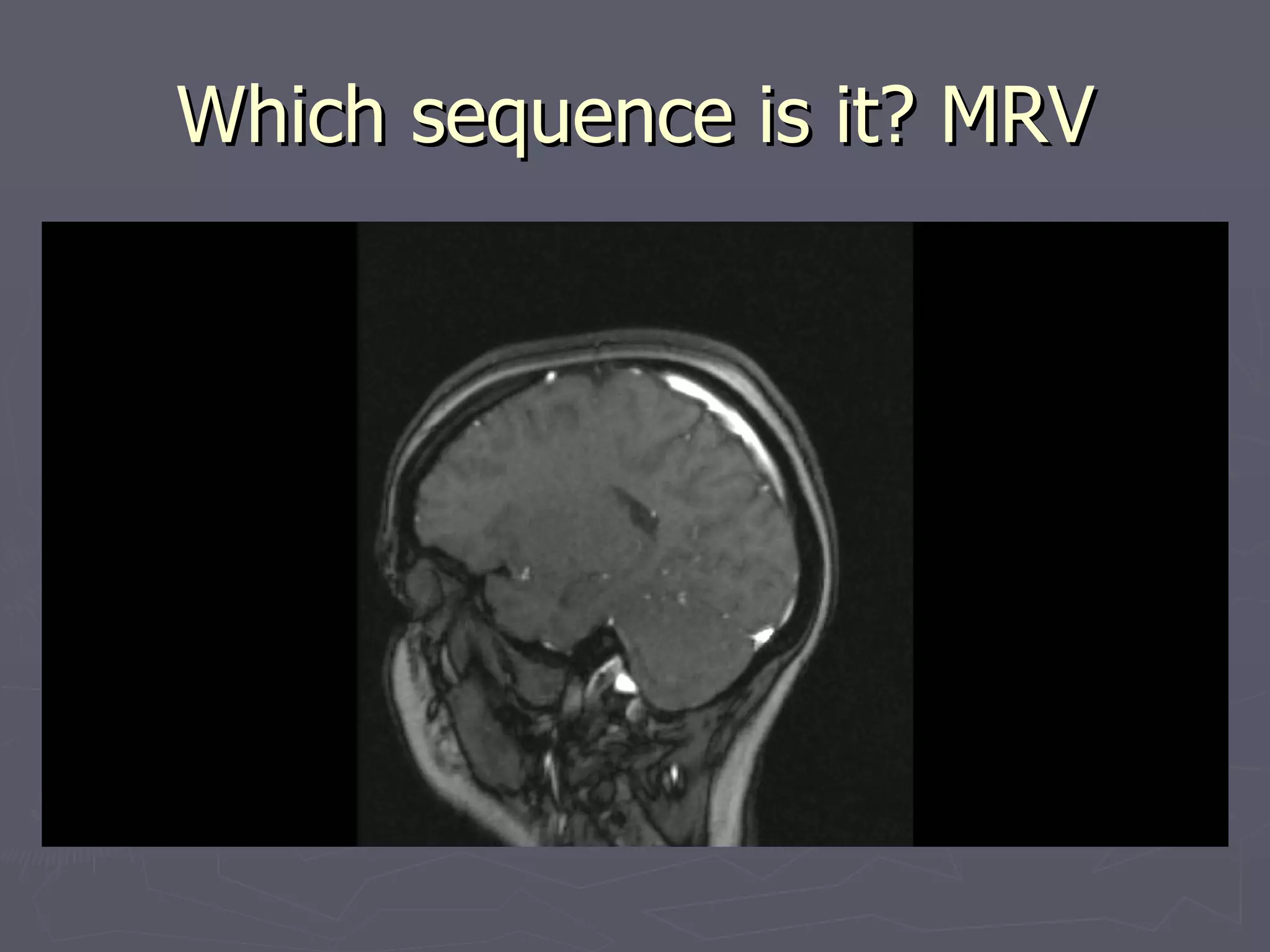 Which sequence is it? MRV 