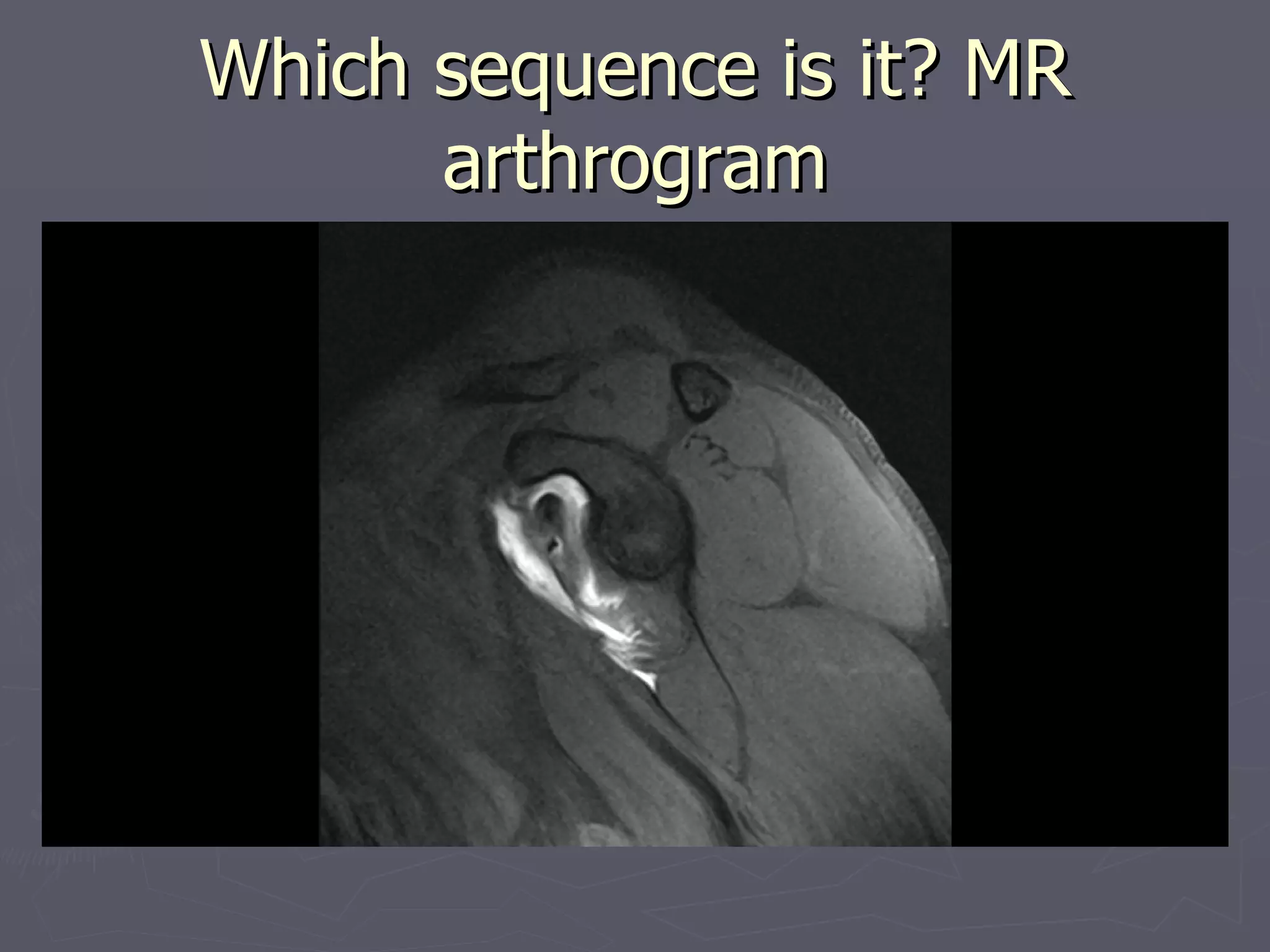 Which sequence is it? MR arthrogram 