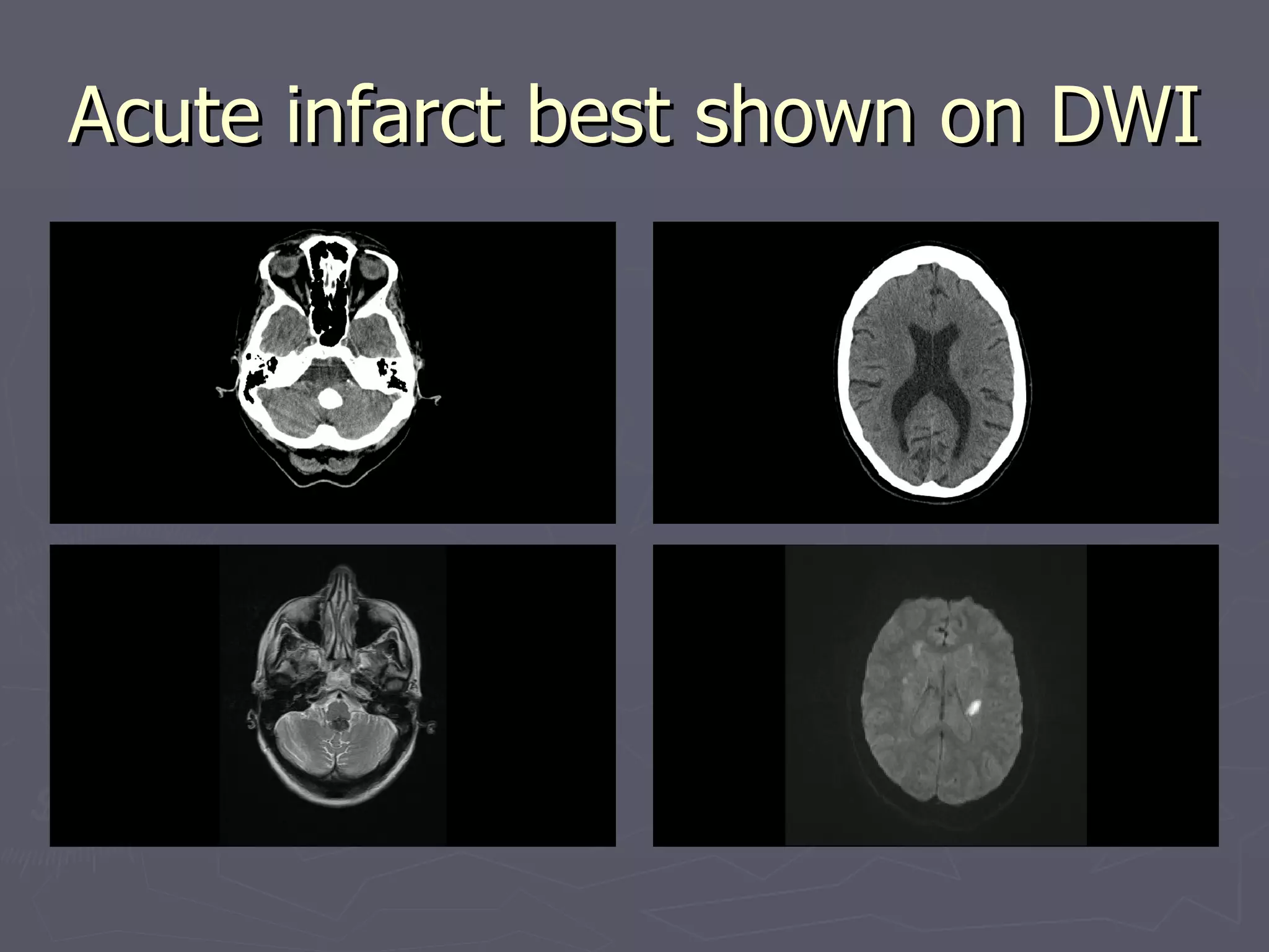 Acute infarct best shown on DWI 