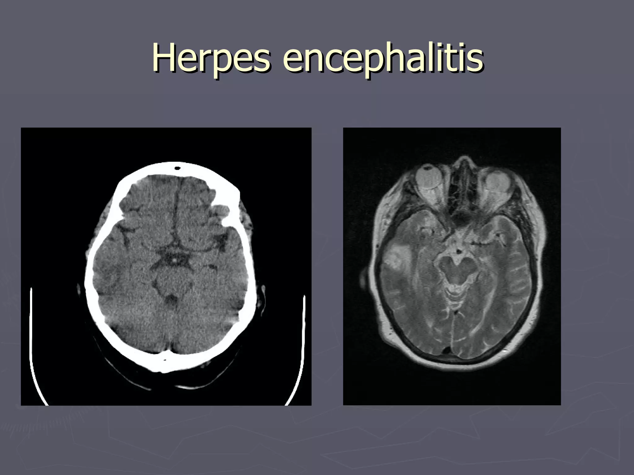 Herpes encephalitis 