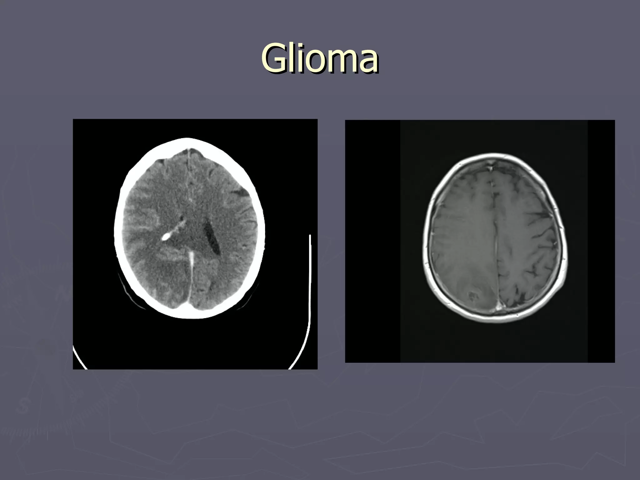 Glioma 