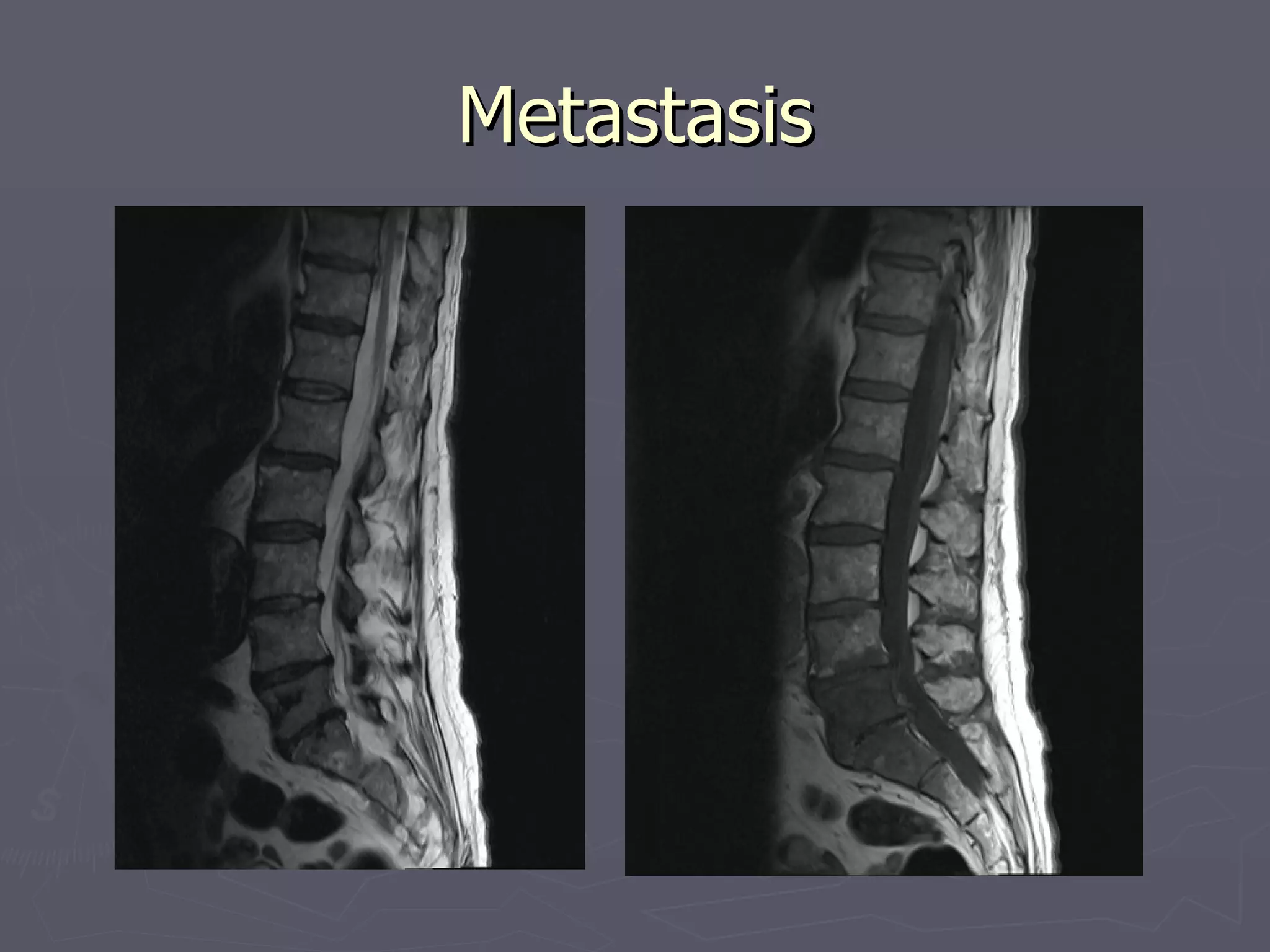 Metastasis 