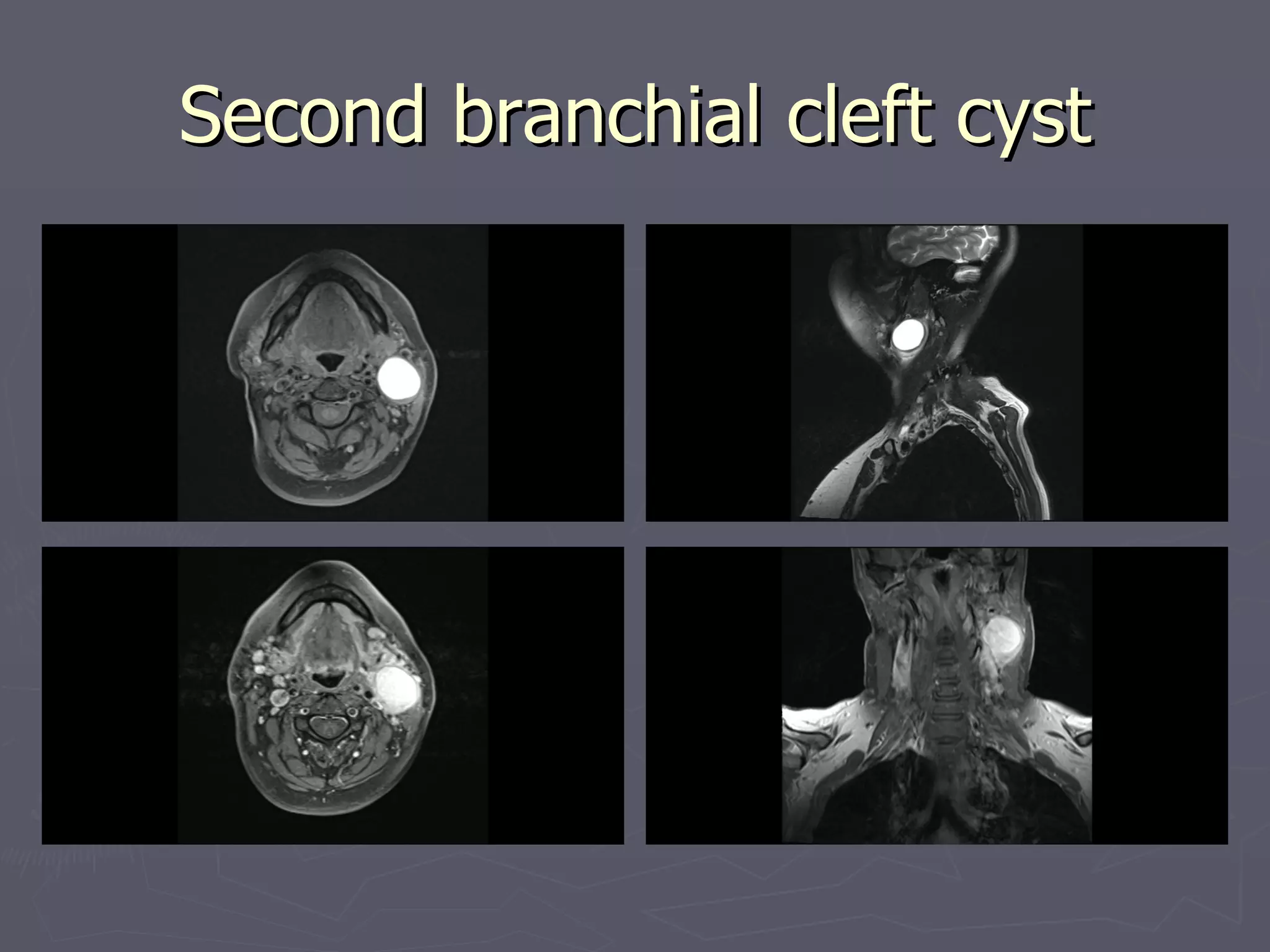 Second branchial cleft cyst 