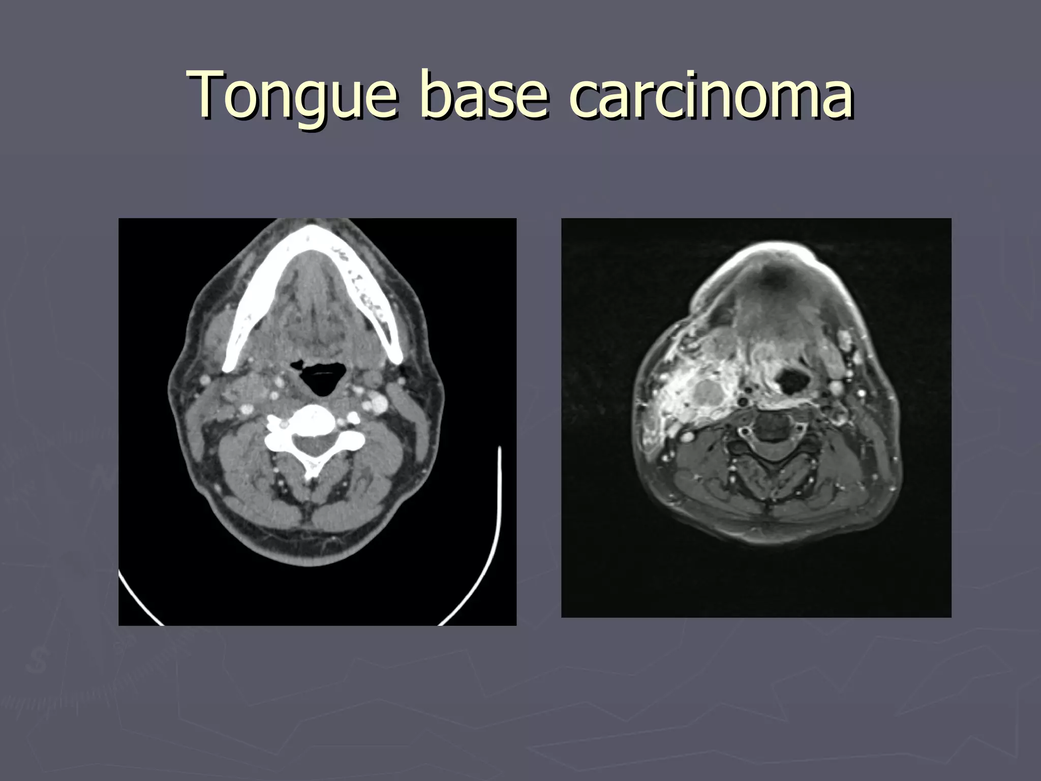 Tongue base carcinoma 