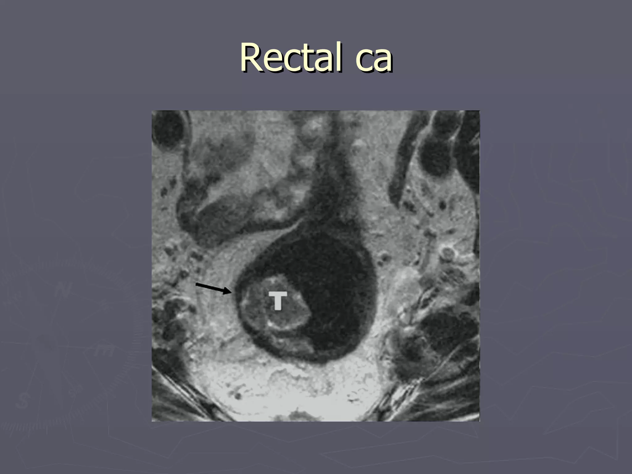 Rectal ca 