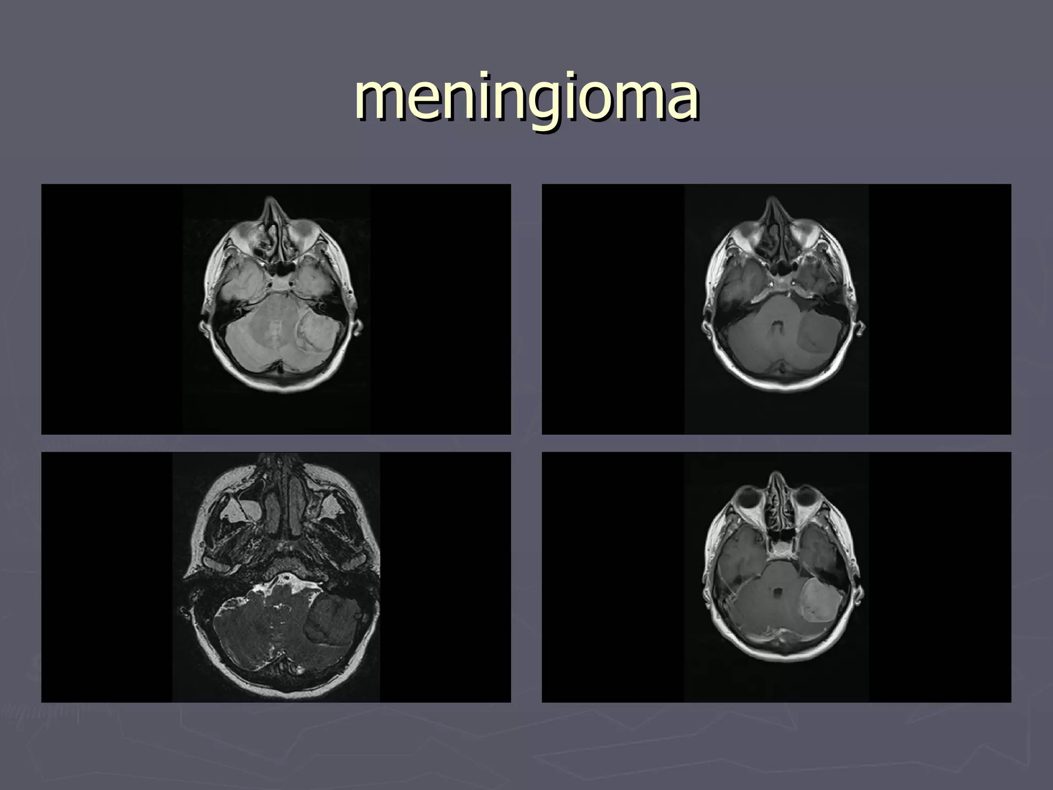 meningioma 