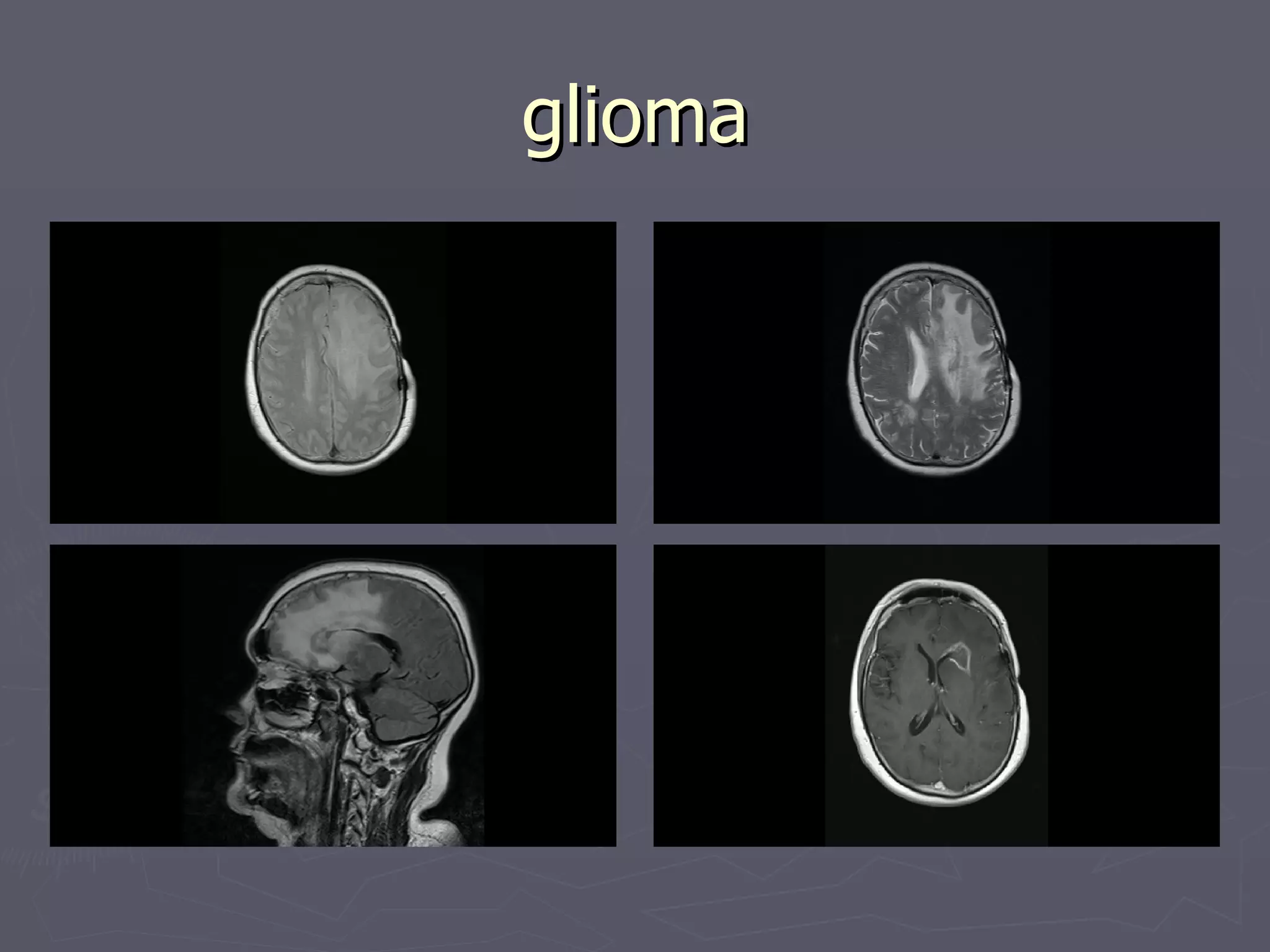 glioma 