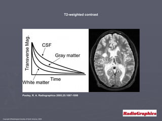 Copyright ©Radiological Society of North America, 2005 Pooley, R. A. Radiographics 2005;25:1087-1099 T2-weighted contrast 