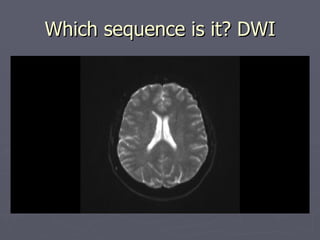 Which sequence is it? DWI 