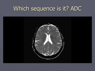 Which sequence is it? ADC 