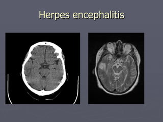 Herpes encephalitis 
