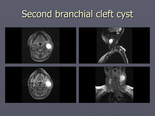 Second branchial cleft cyst 